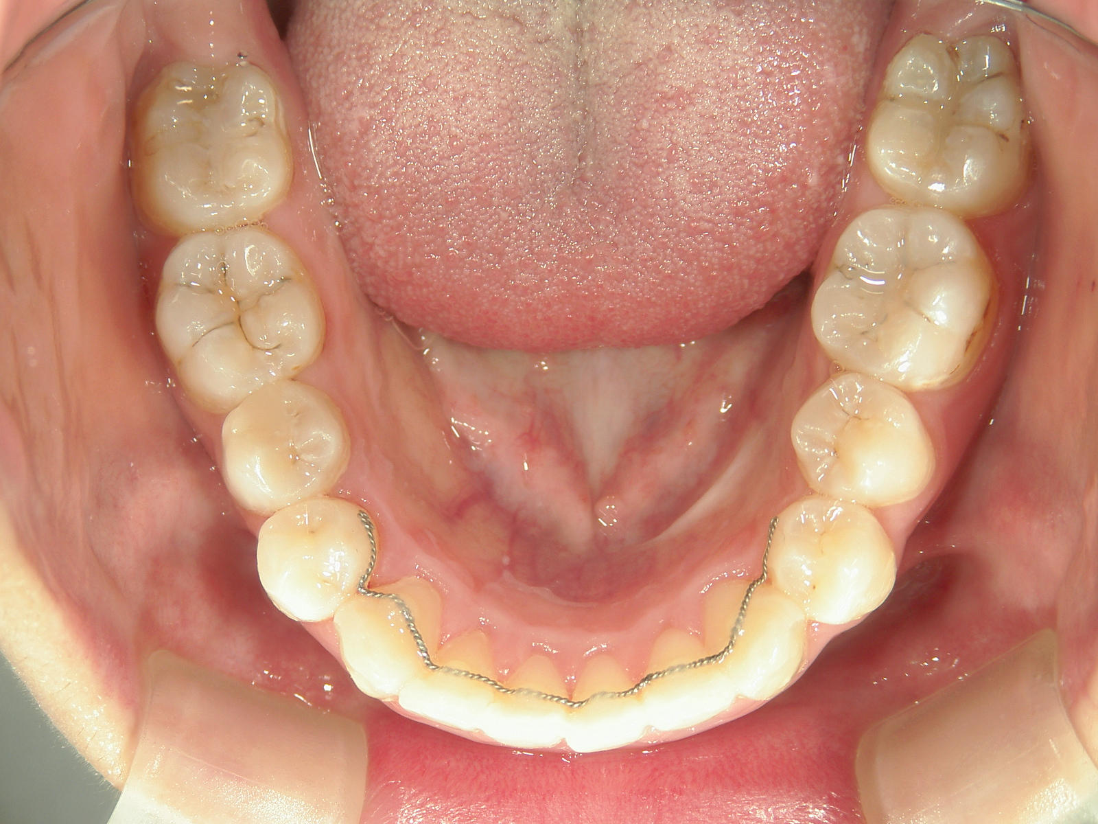 舌側ワイヤー矯正　症例（2）