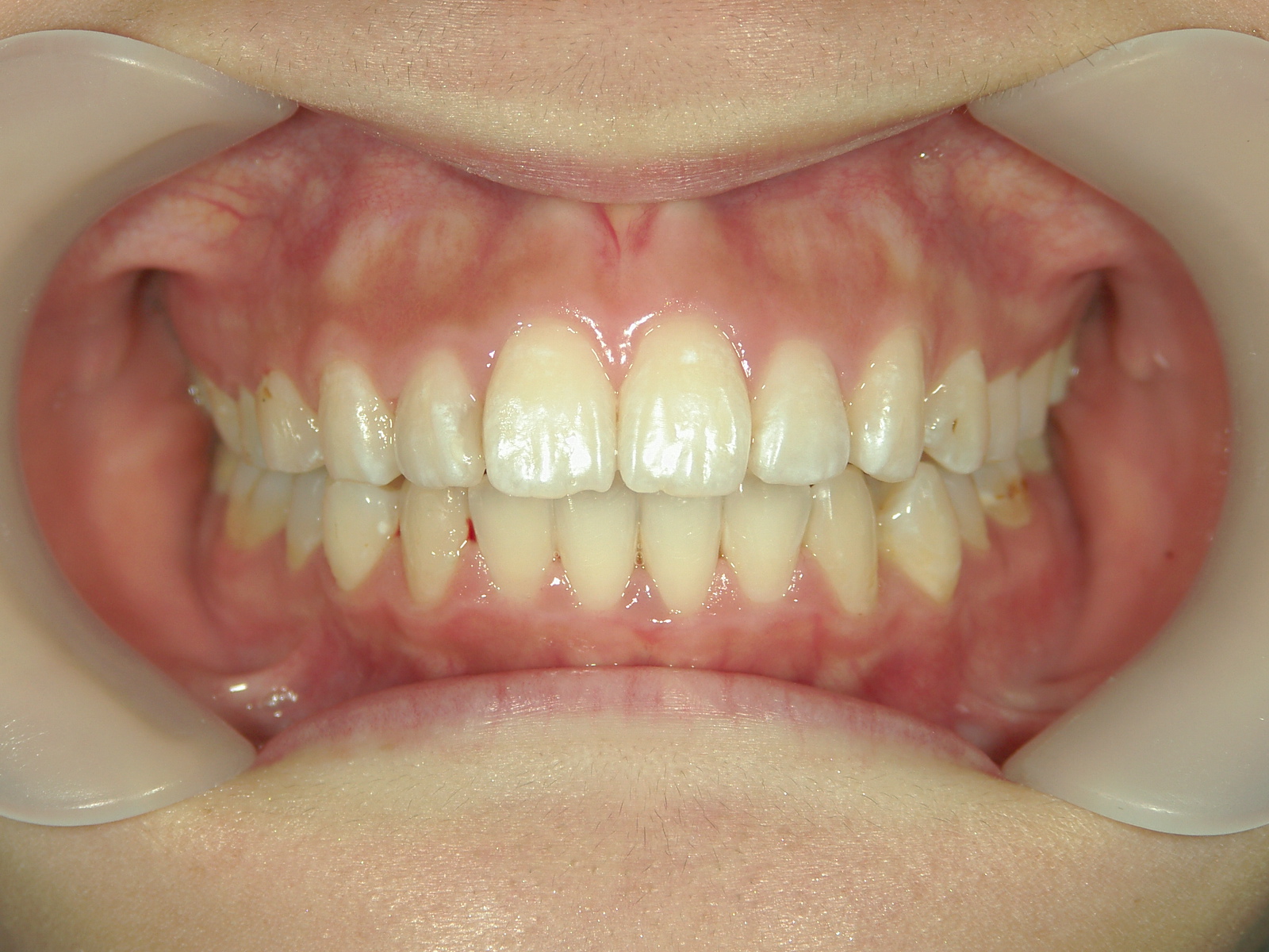 舌側ワイヤー矯正　症例（2）