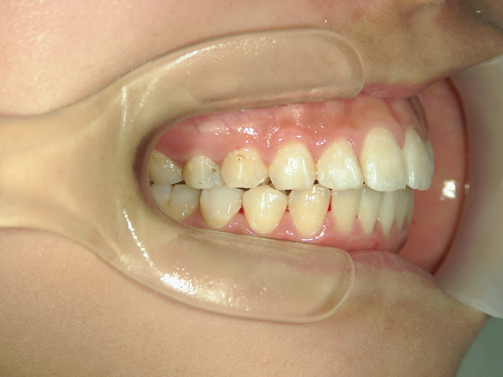 舌側ワイヤー矯正　症例（2）
