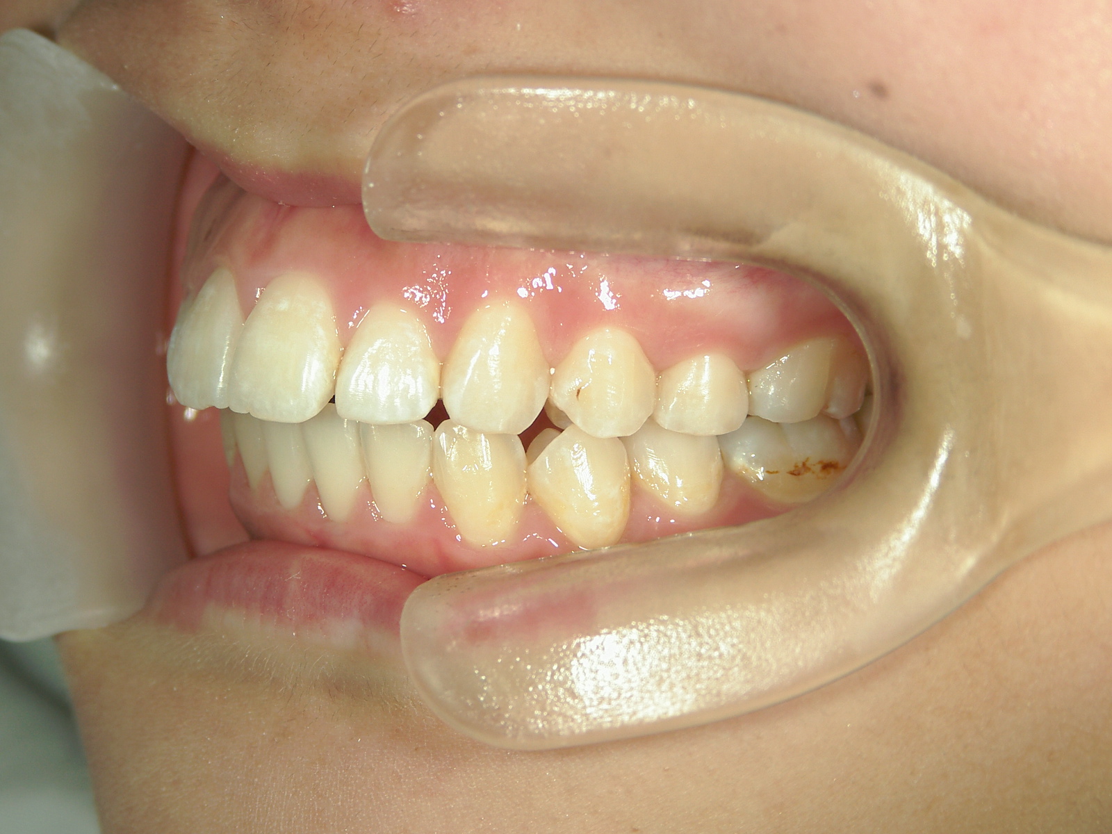 舌側ワイヤー矯正　症例（2）