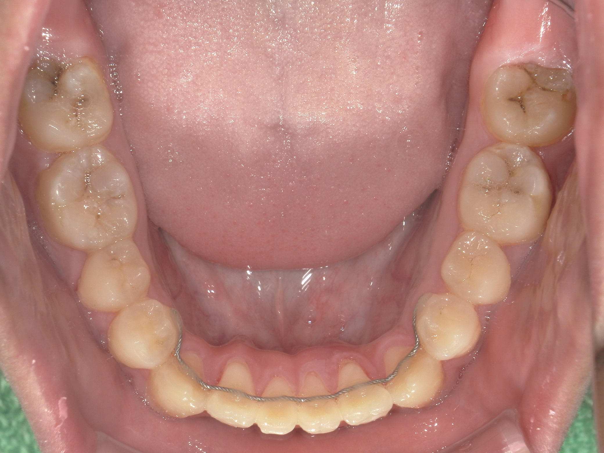 全顎ワイヤー矯正　症例（8）