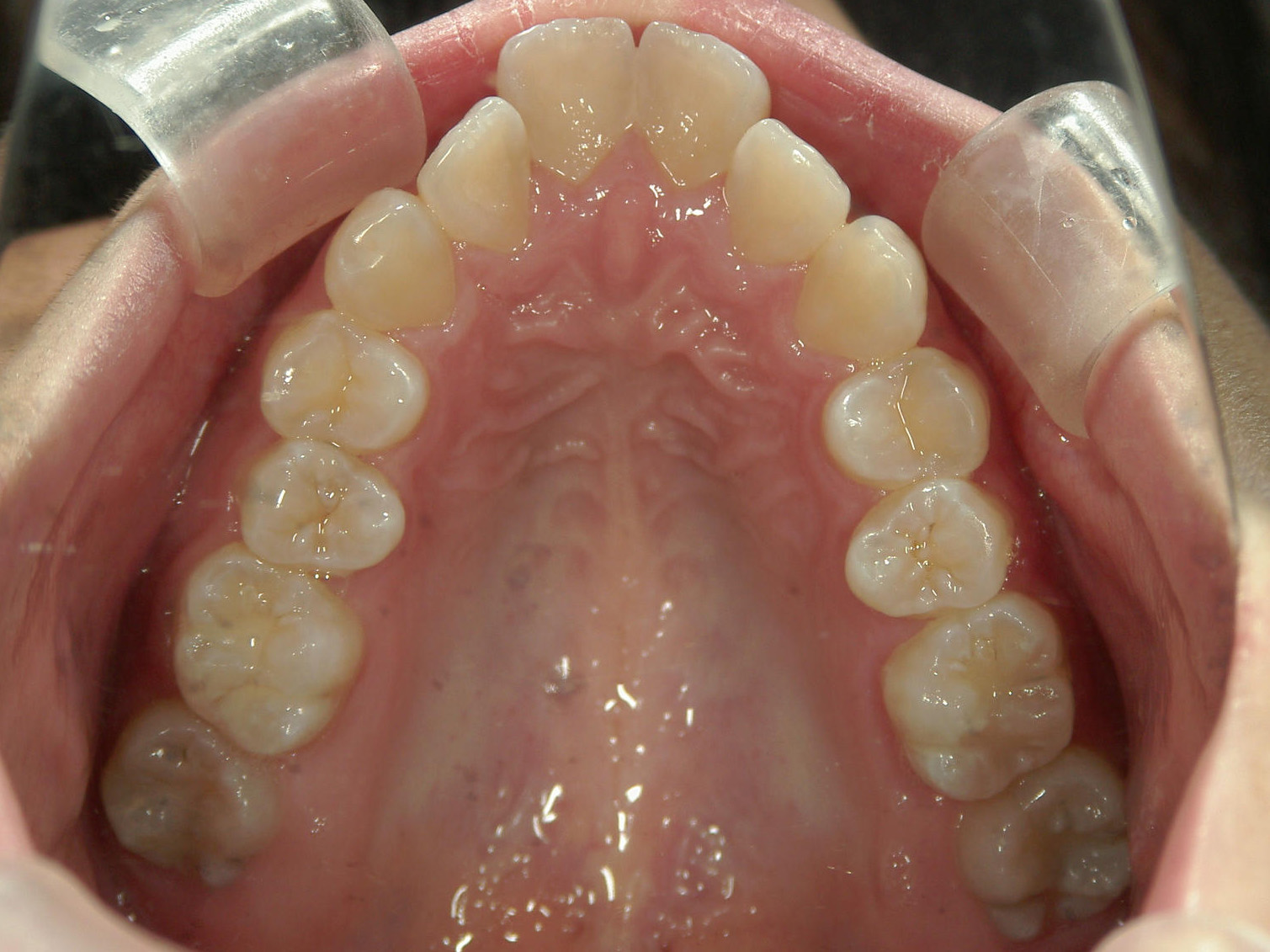 舌側ワイヤー矯正　症例（2）