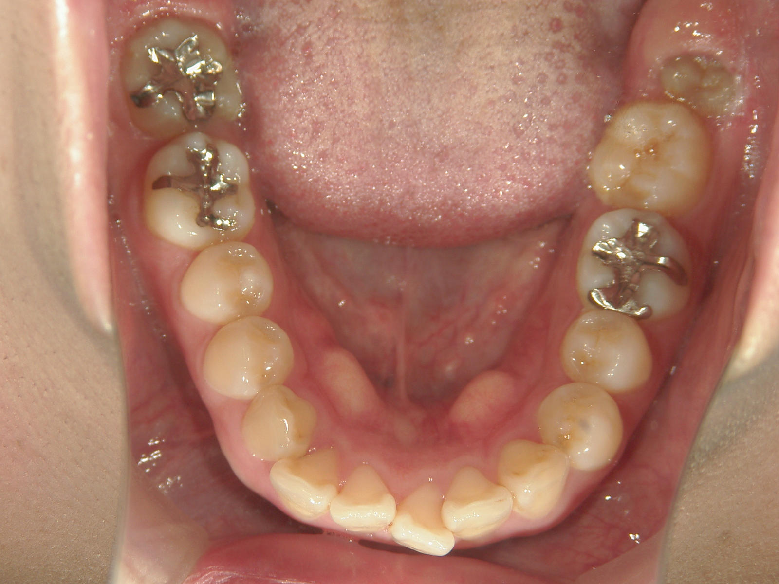 舌側ワイヤー矯正　症例（8）