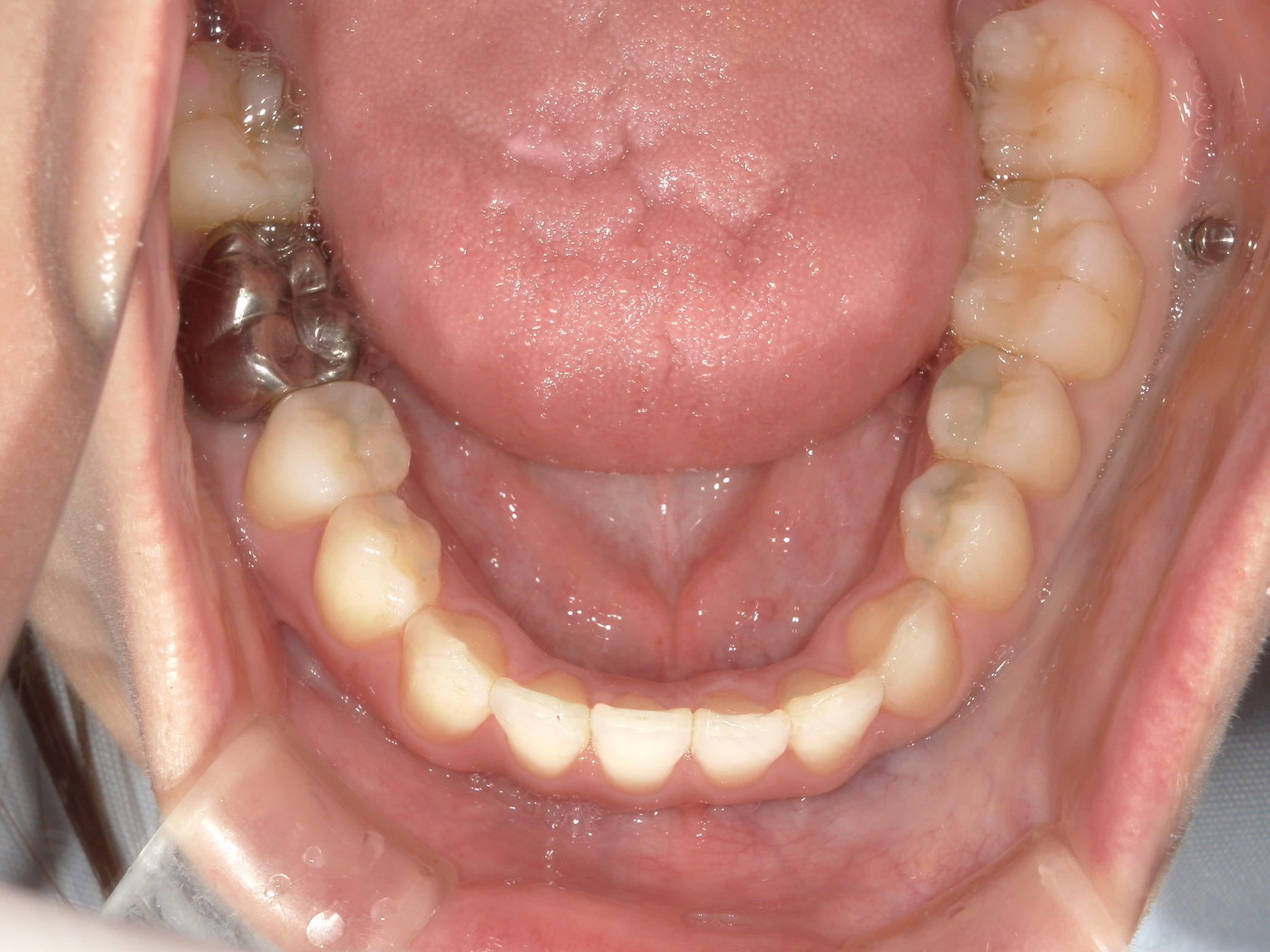 舌側ワイヤー矯正　症例（7）