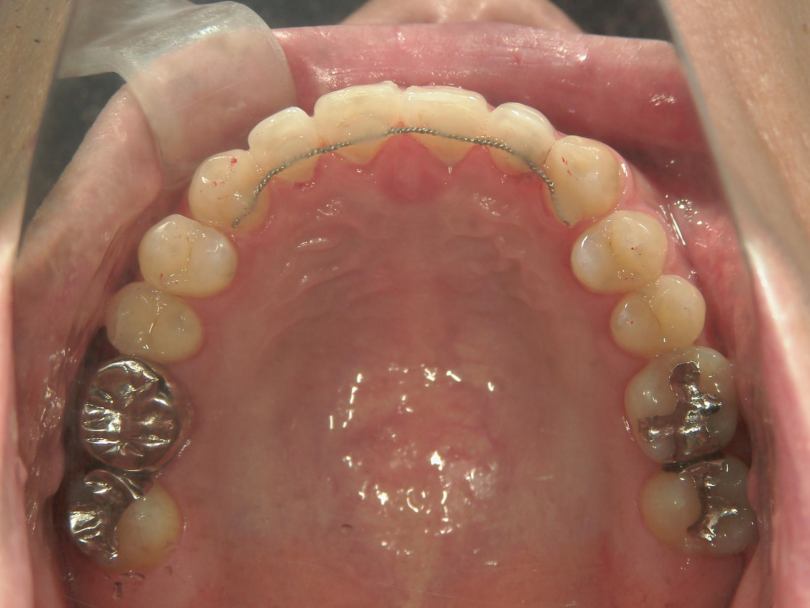 プチ舌側ワイヤー矯正　症例（10）