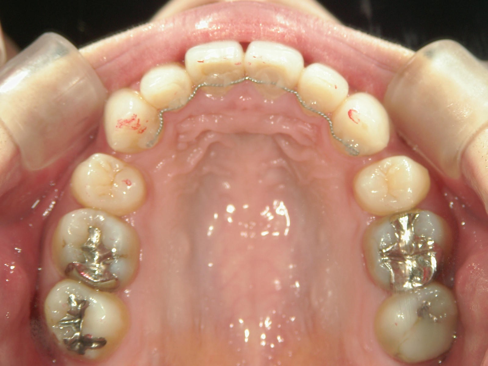 舌側ワイヤー矯正　症例（14）