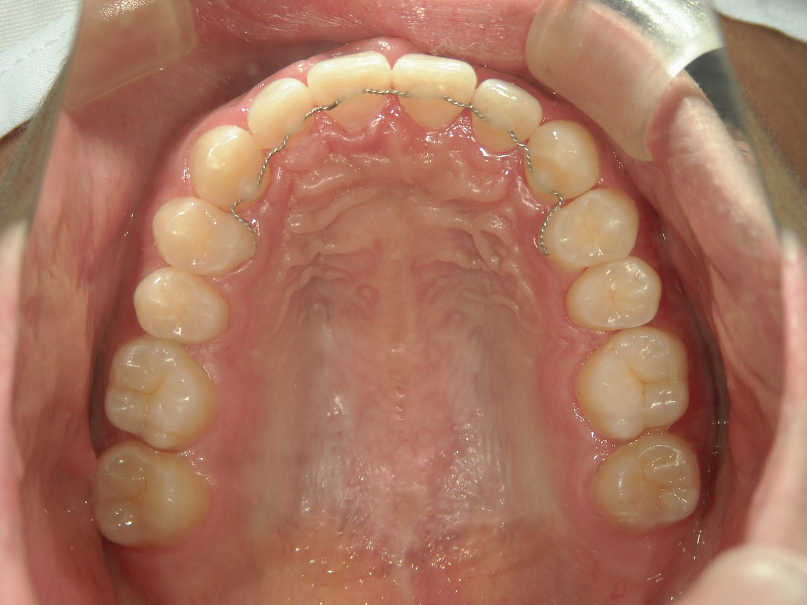 舌側ワイヤー矯正　症例（17）