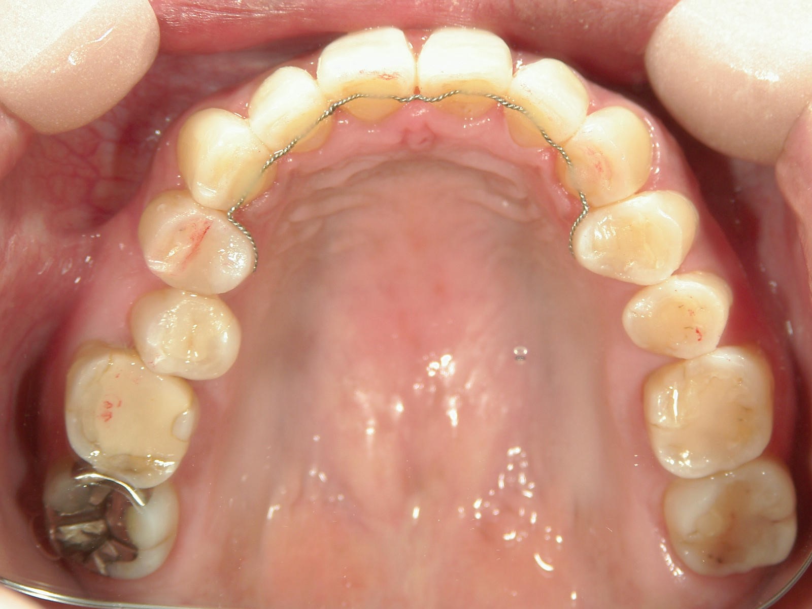 プチ舌側ワイヤー矯正　症例（18）