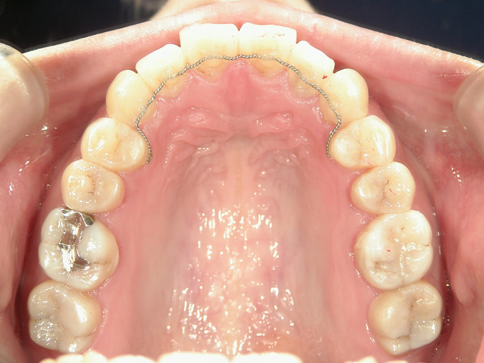 プチ舌側ワイヤー矯正　症例（19）