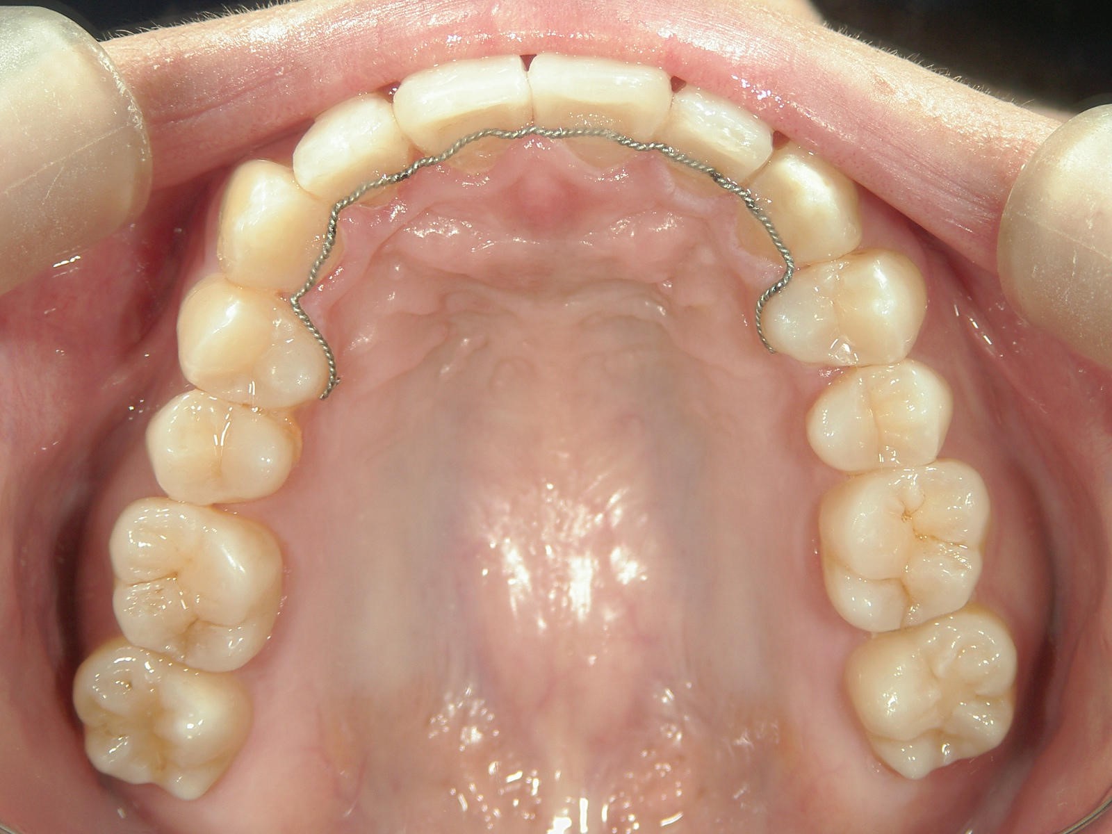 プチ舌側ワイヤー矯正　症例（24）