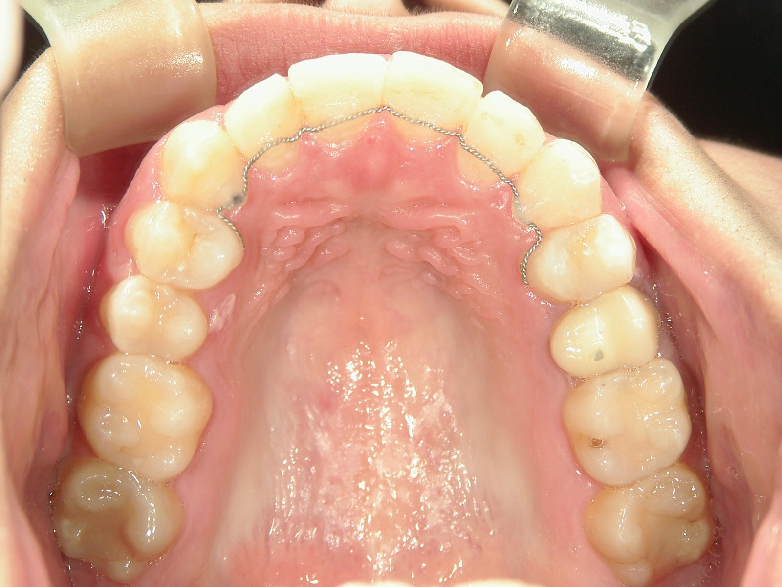 プチワイヤー矯正　症例（27）
