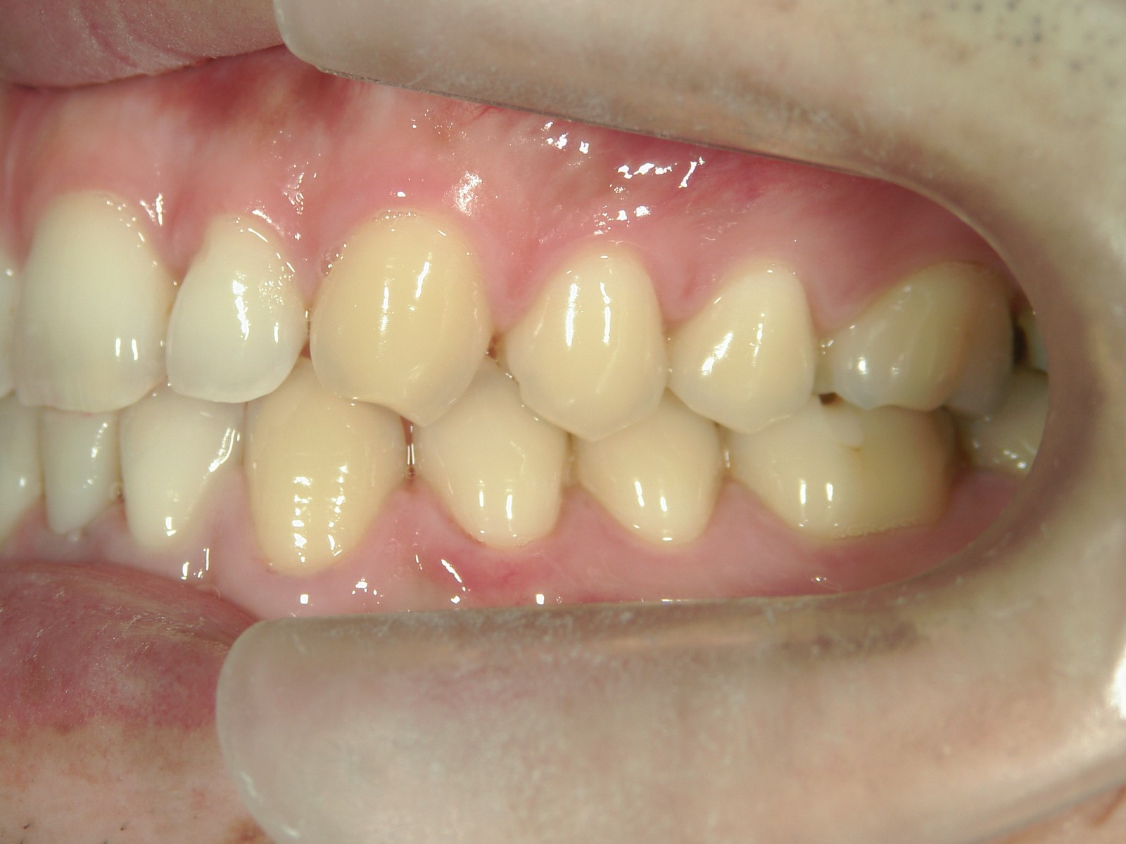 プチ舌側ワイヤー矯正　症例（10）