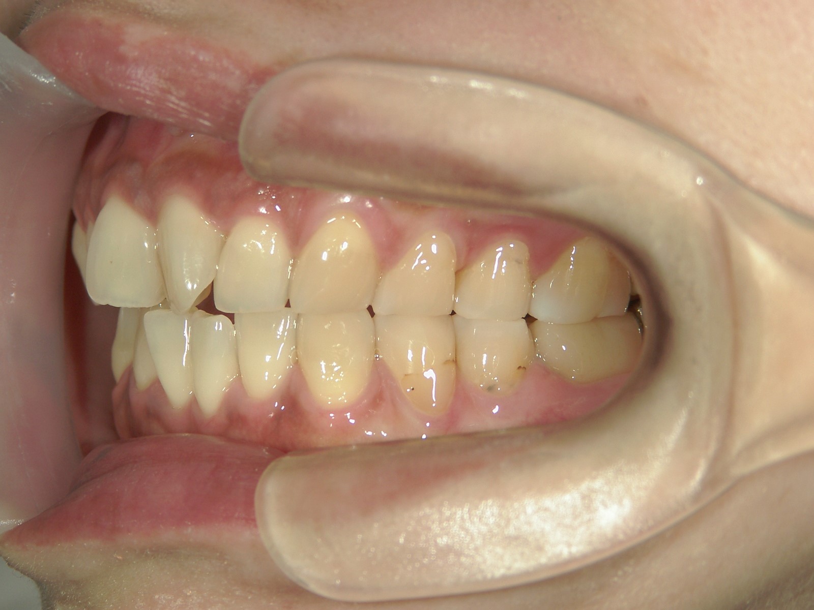 プチ舌側ワイヤー矯正　症例（18）