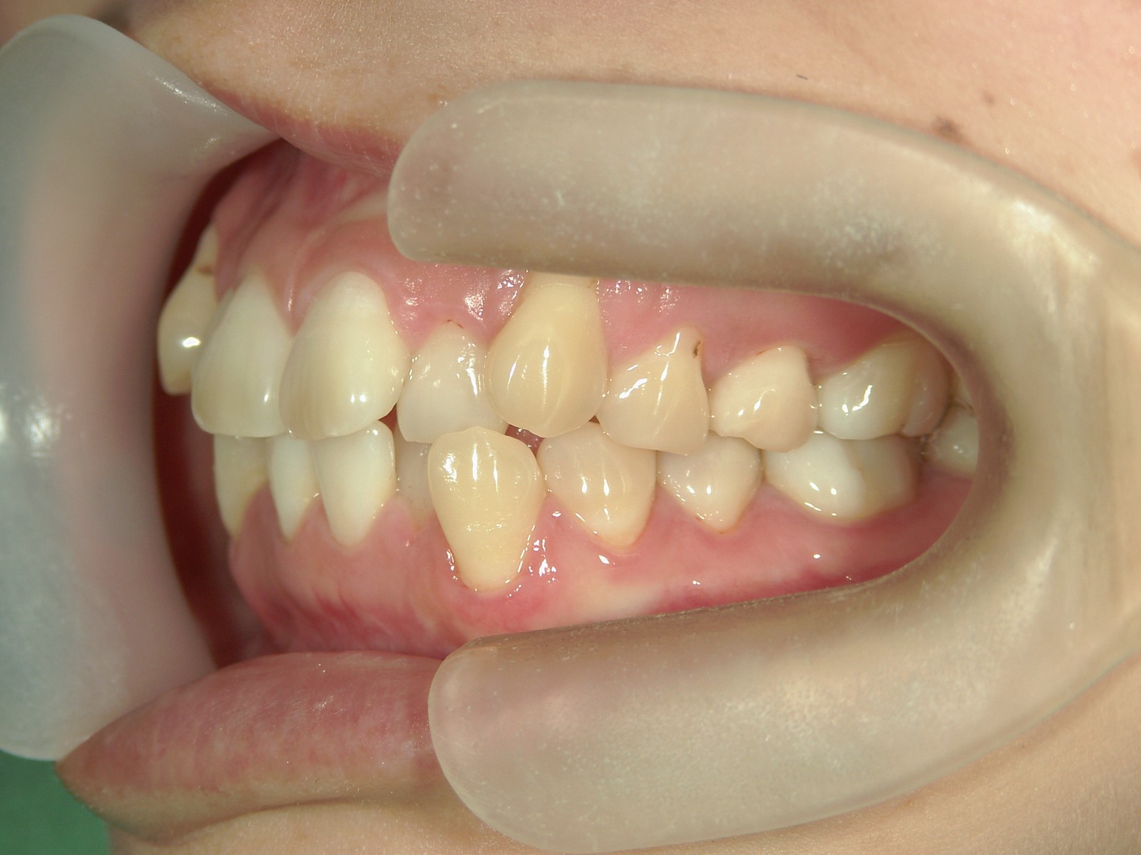 プチ舌側ワイヤー矯正　症例（19）