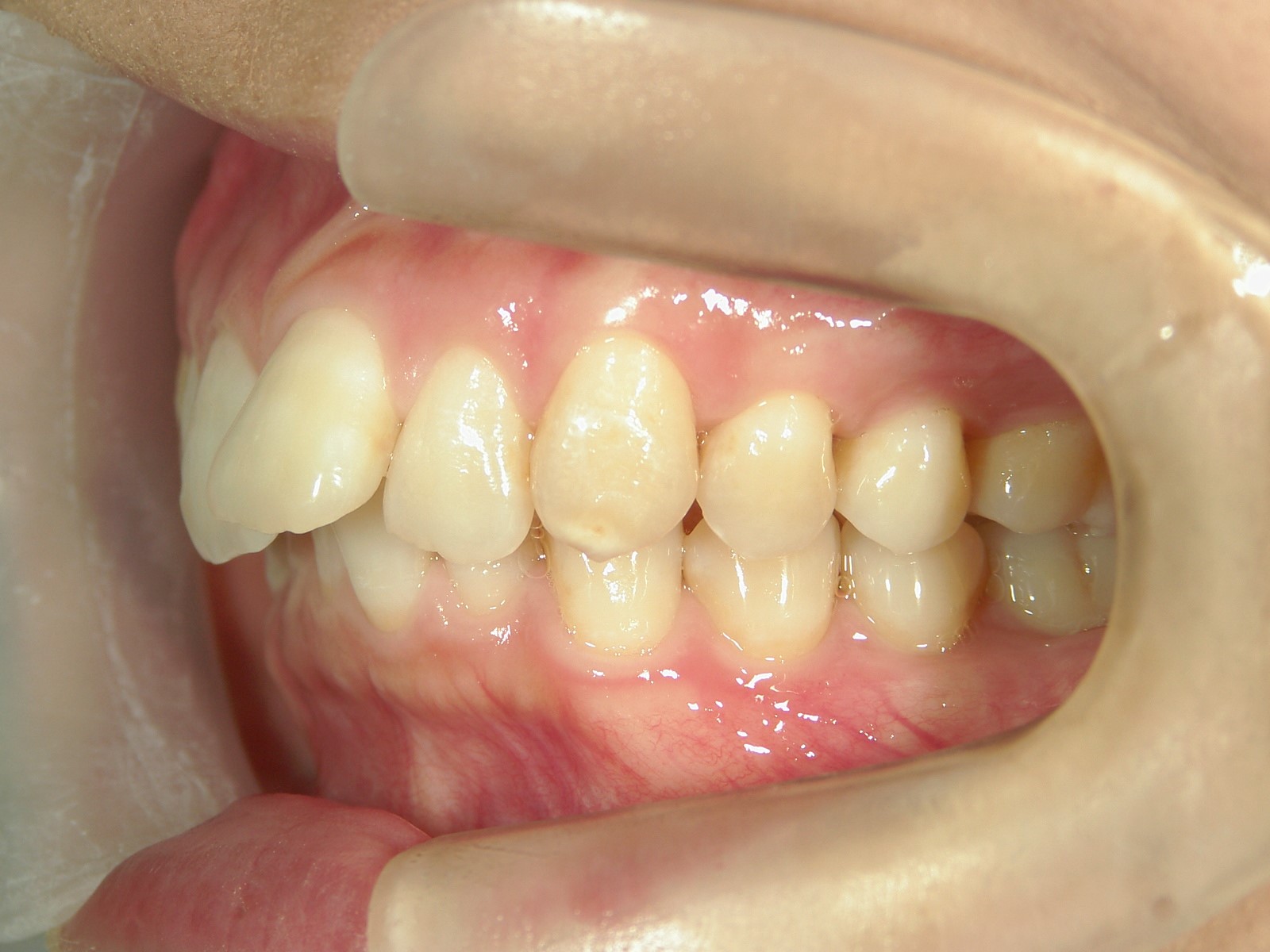 プチ舌側ワイヤー矯正　症例（24）