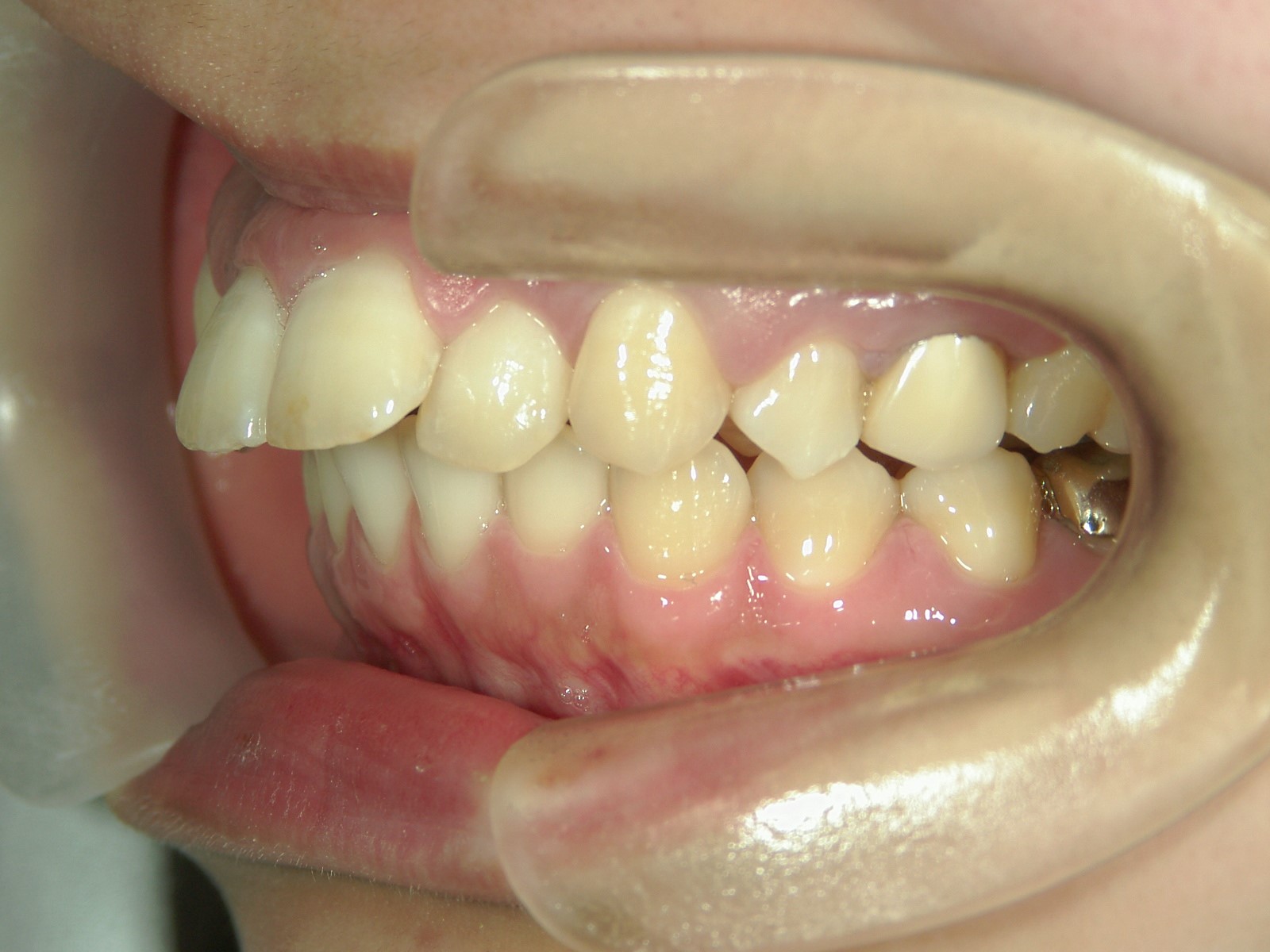 プチワイヤー矯正　症例（27）