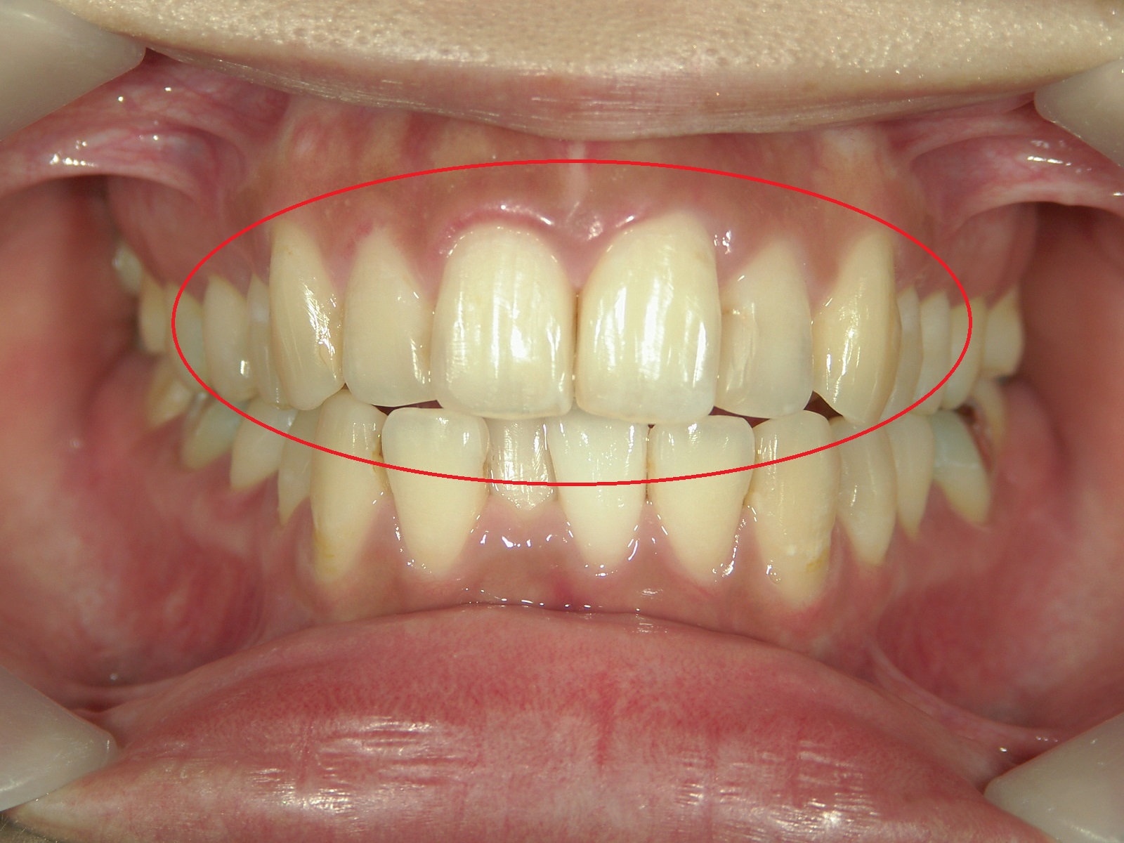 プチ舌側ワイヤー矯正　症例（20）