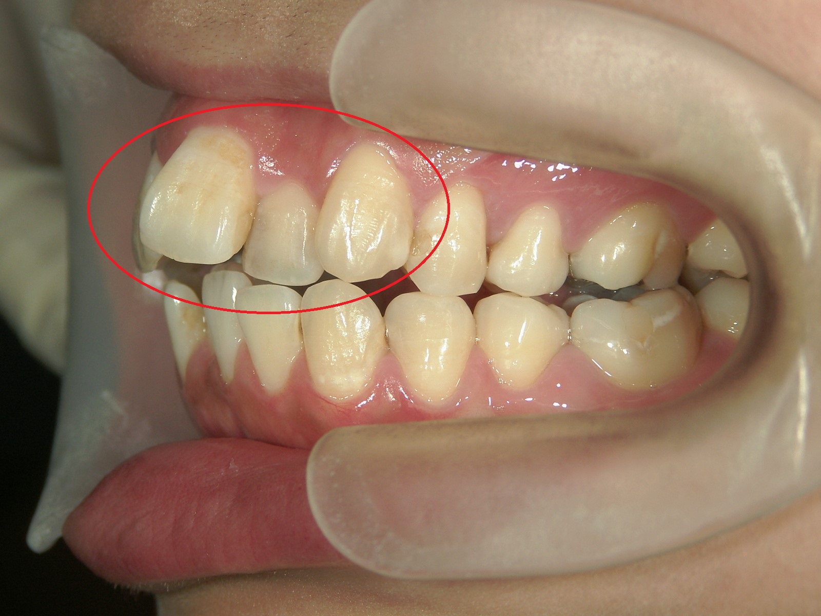 プチ舌側ワイヤー矯正　症例（20）