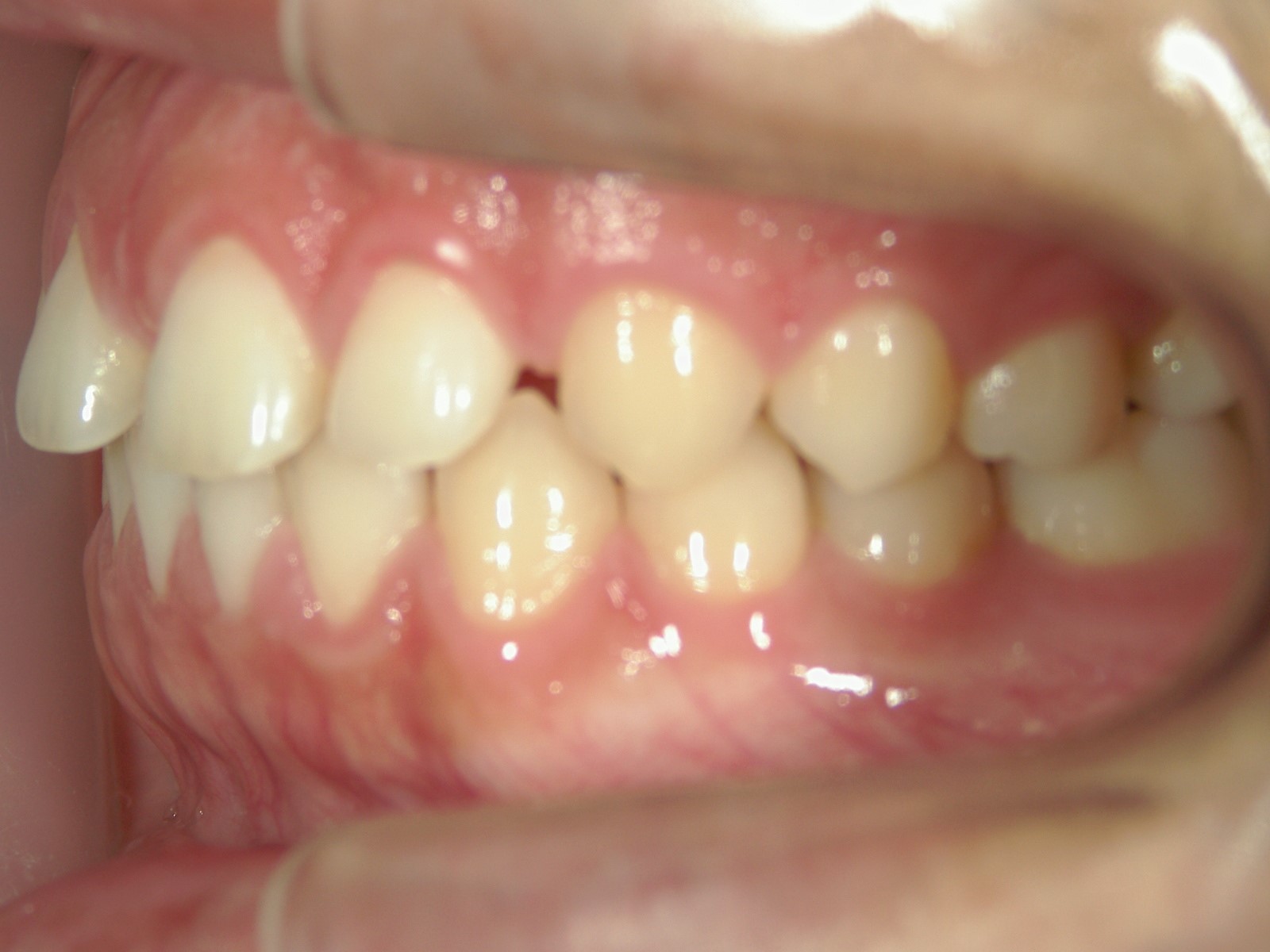 舌側ワイヤー矯正　症例（17）