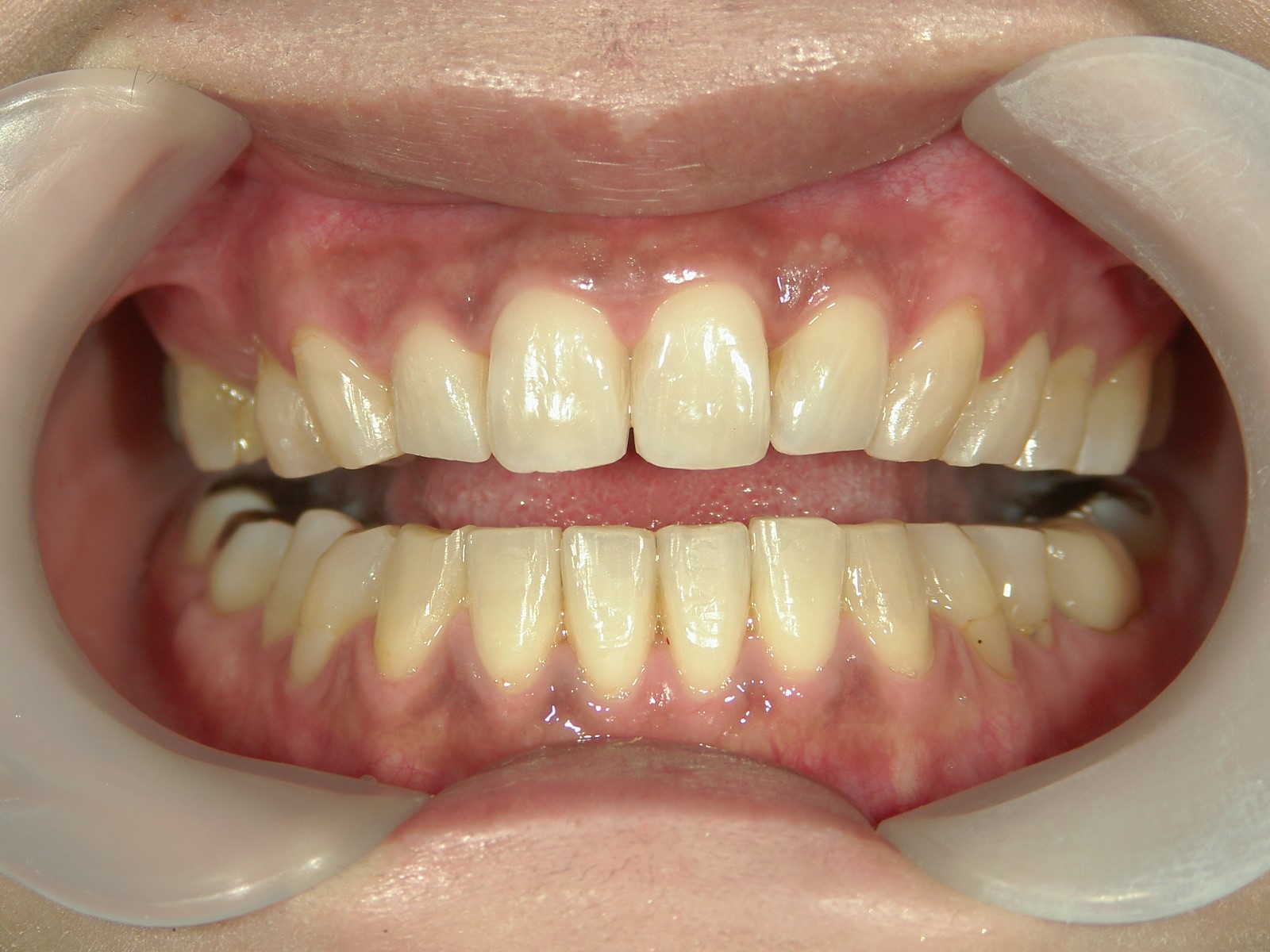 プチ舌側ワイヤー矯正　症例（18）