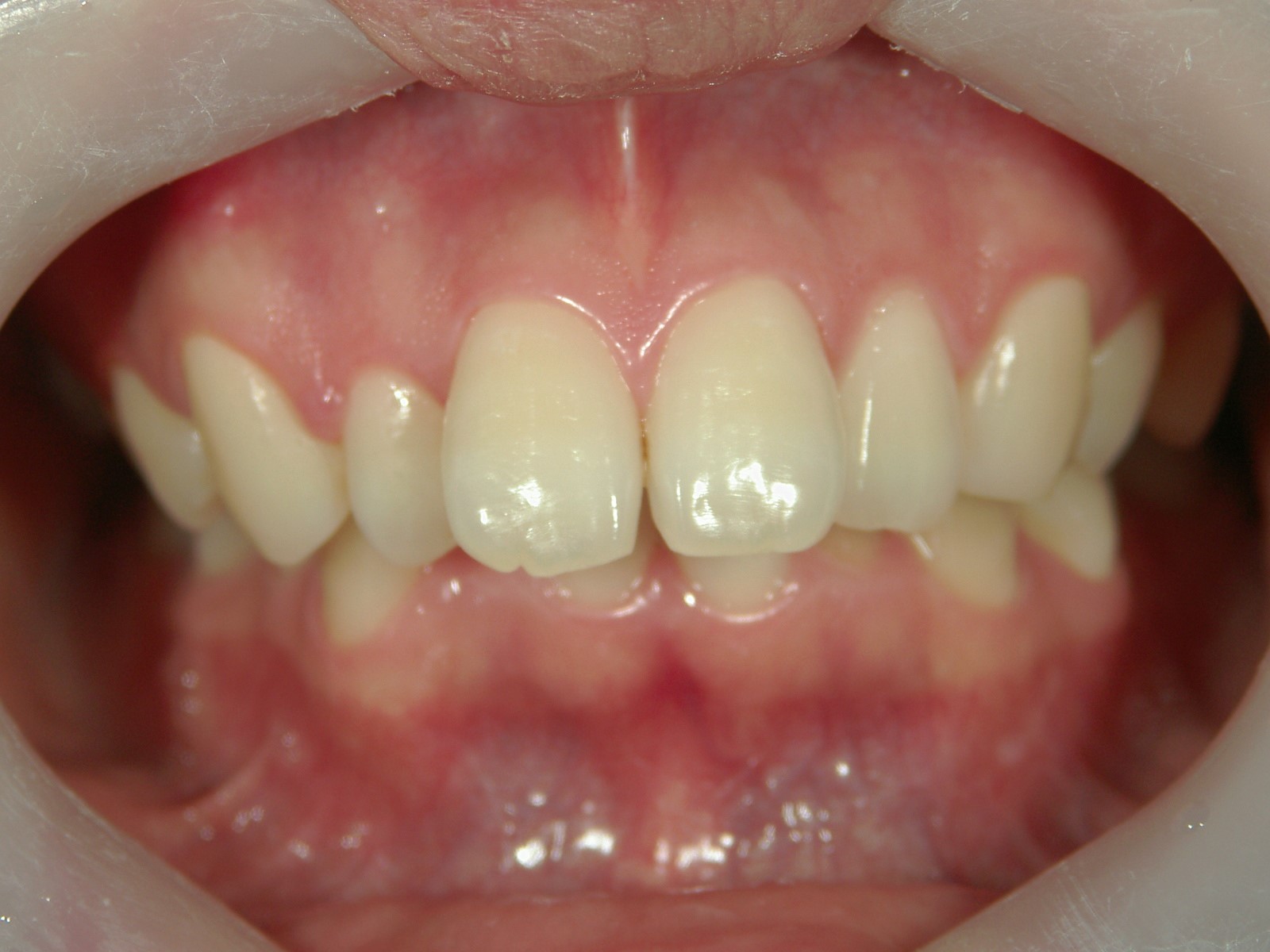 舌側ワイヤー矯正　症例（14）