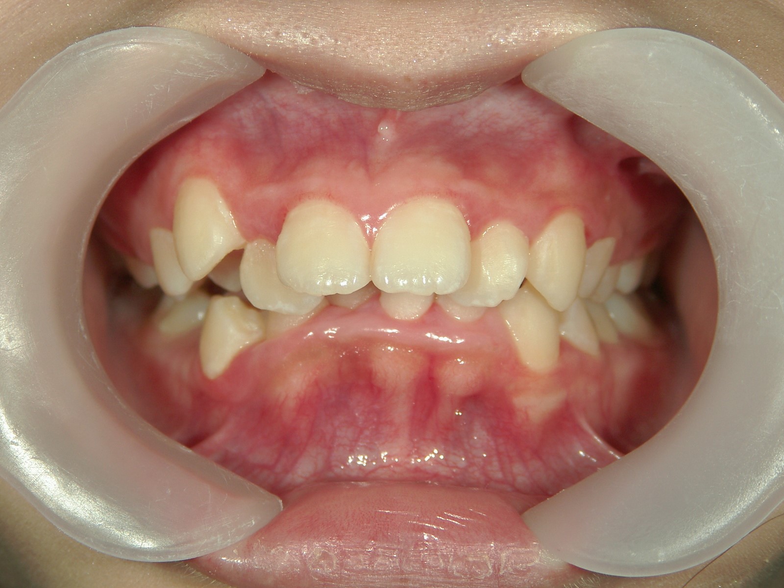 舌側ワイヤー矯正　症例（21）