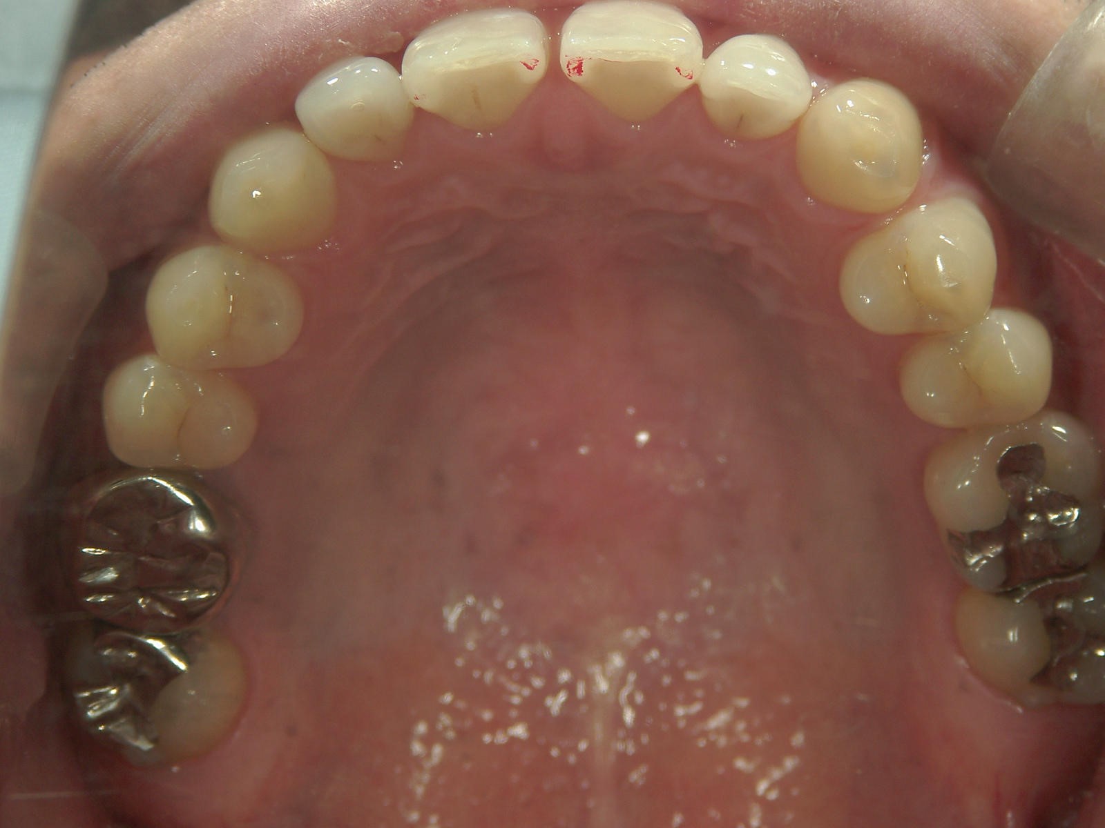 プチ舌側ワイヤー矯正　症例（10）