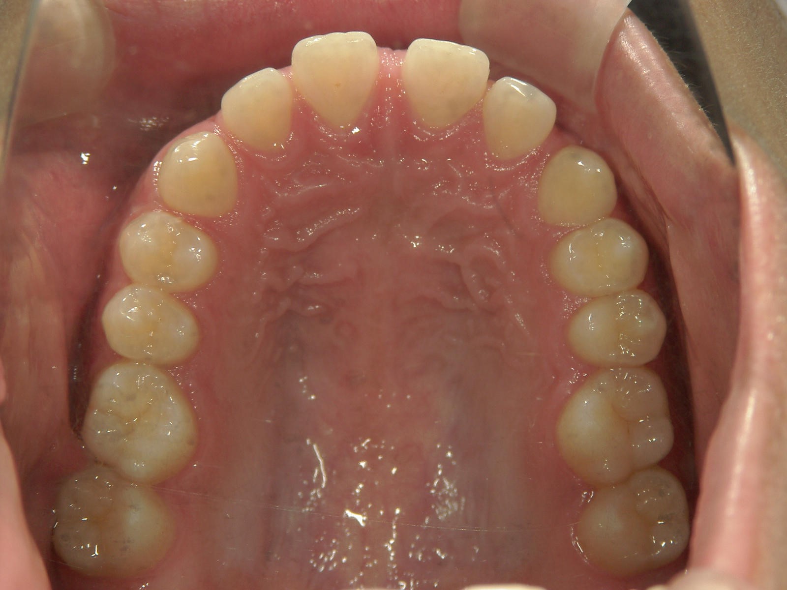 舌側ワイヤー矯正　症例（17）