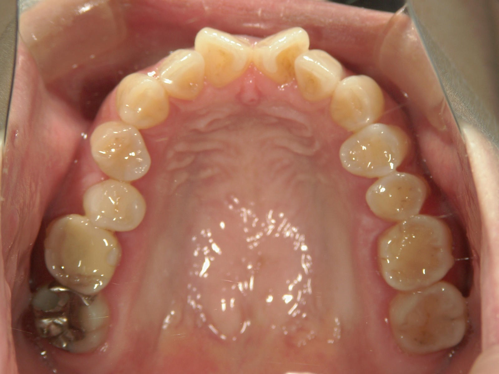 プチ舌側ワイヤー矯正　症例（18）