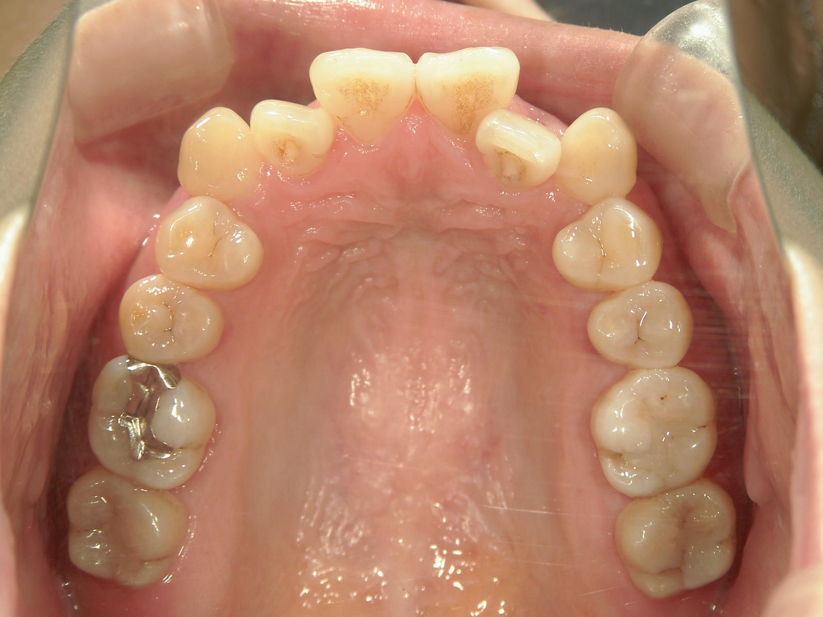 プチ舌側ワイヤー矯正　症例（19）