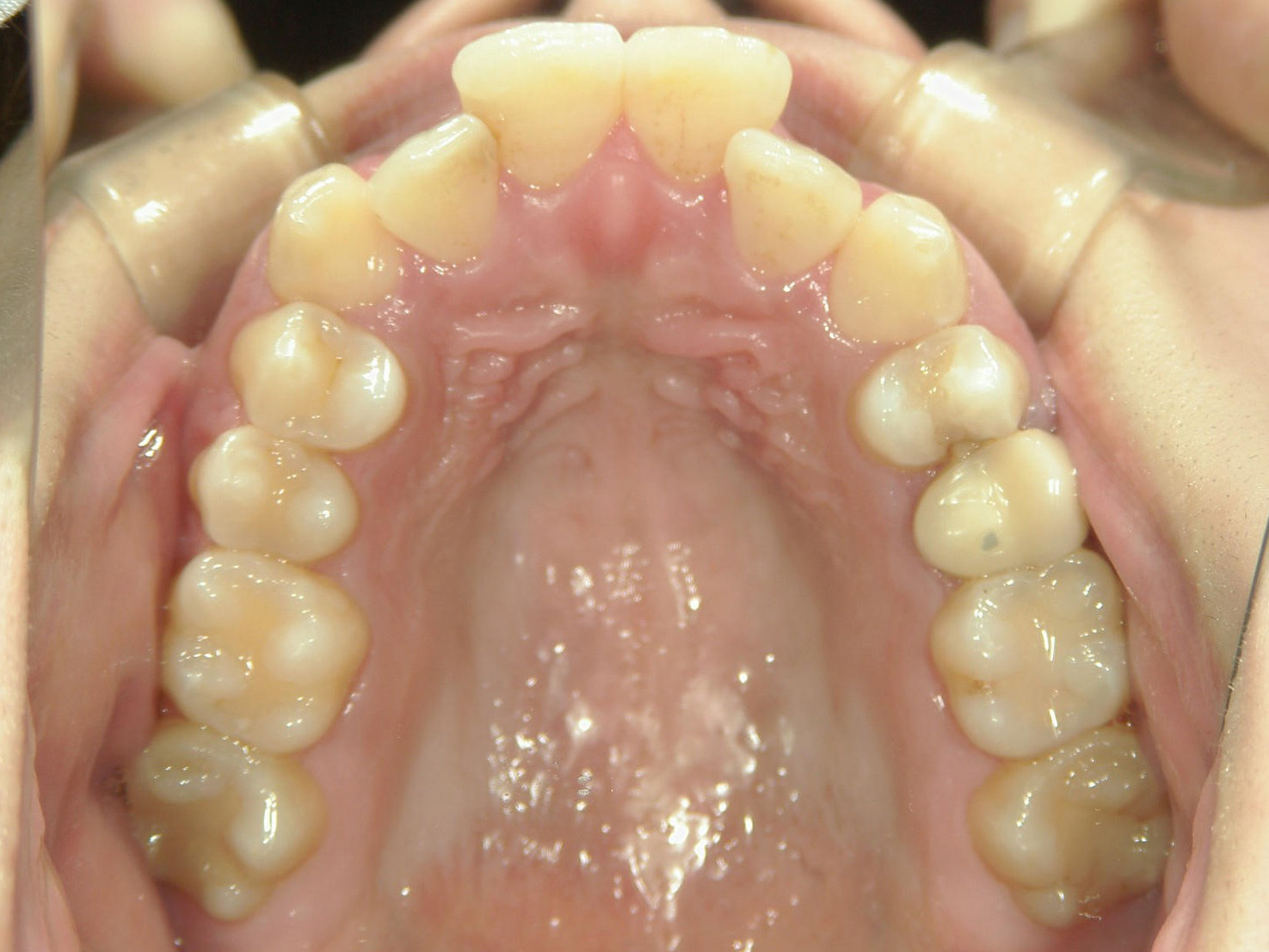 プチワイヤー矯正　症例（27）