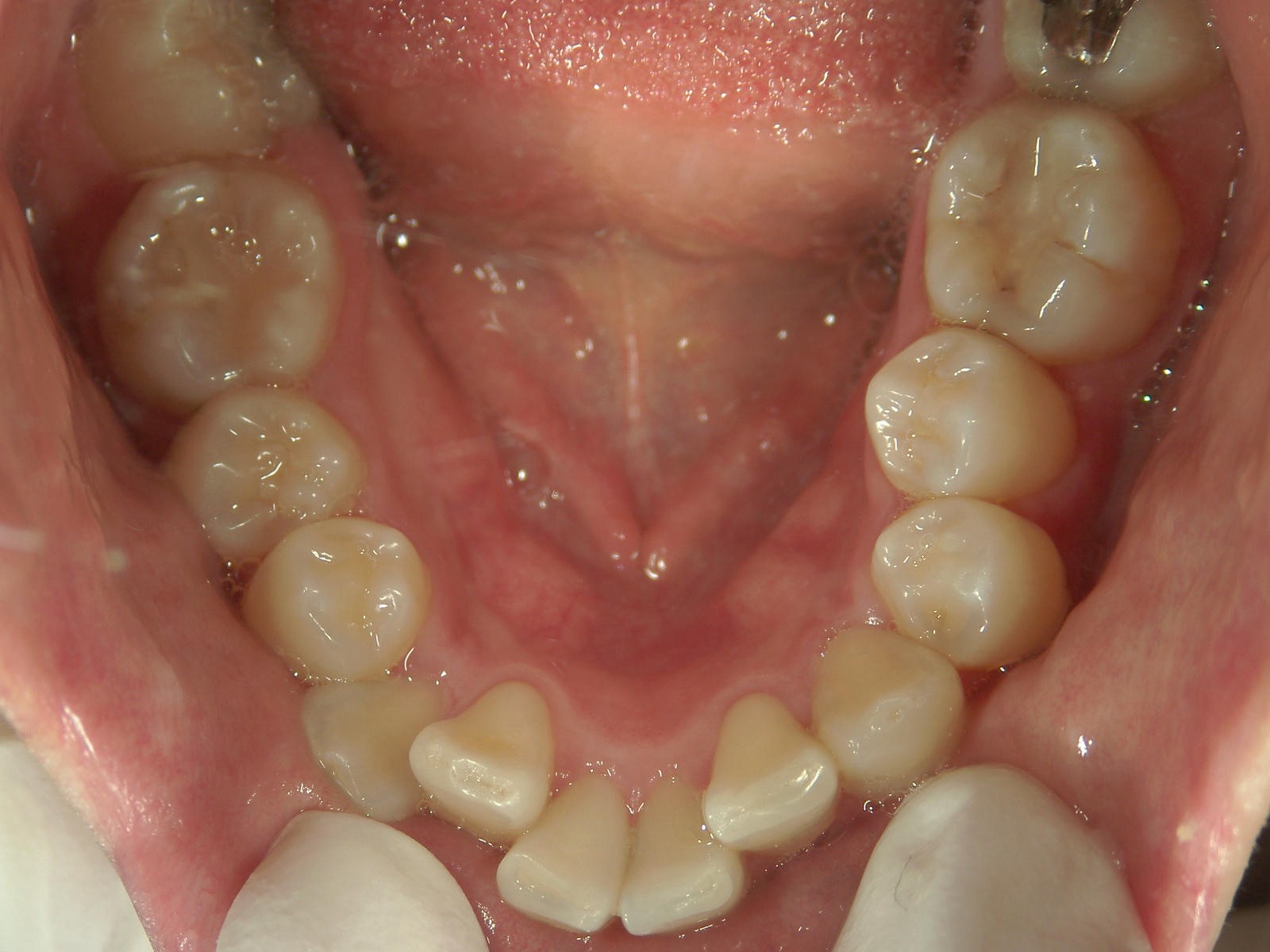 舌側ワイヤー矯正　症例（14）