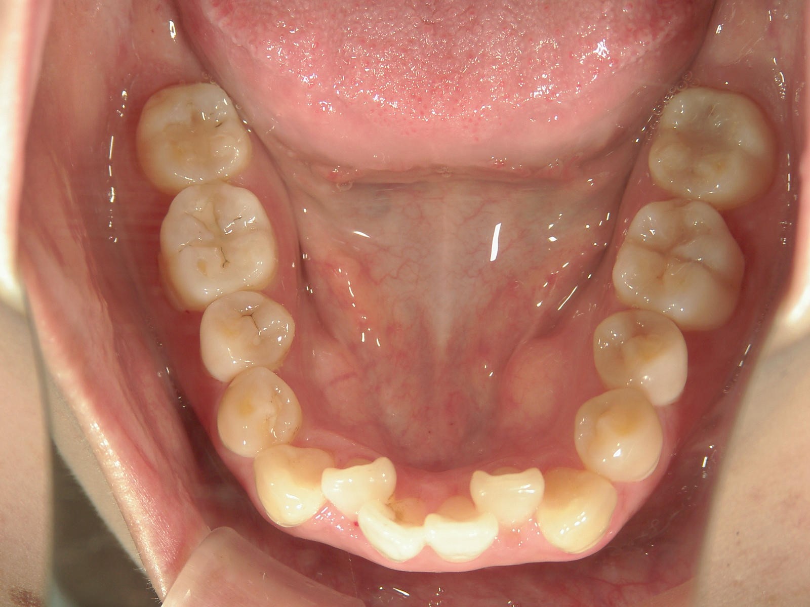 プチ舌側ワイヤー矯正　症例（19）