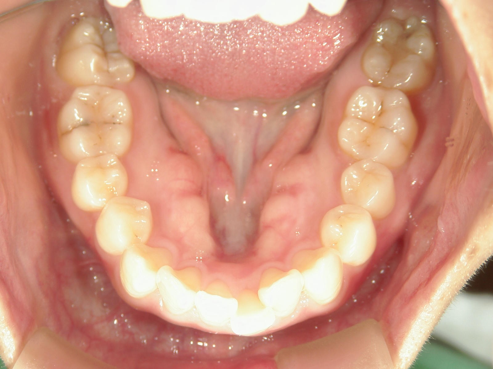 プチ舌側ワイヤー矯正　症例（24）