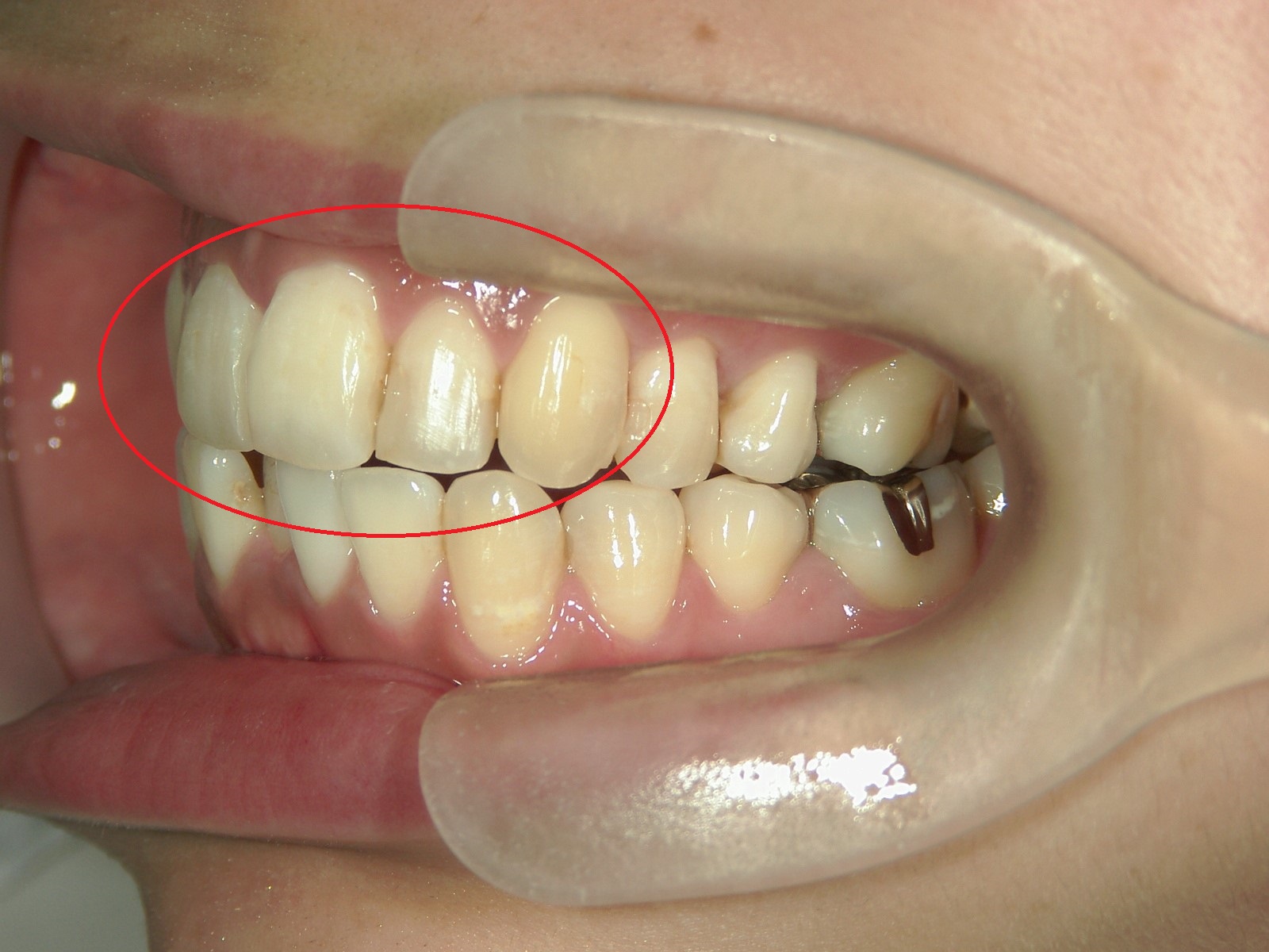 プチ舌側ワイヤー矯正　症例（20）