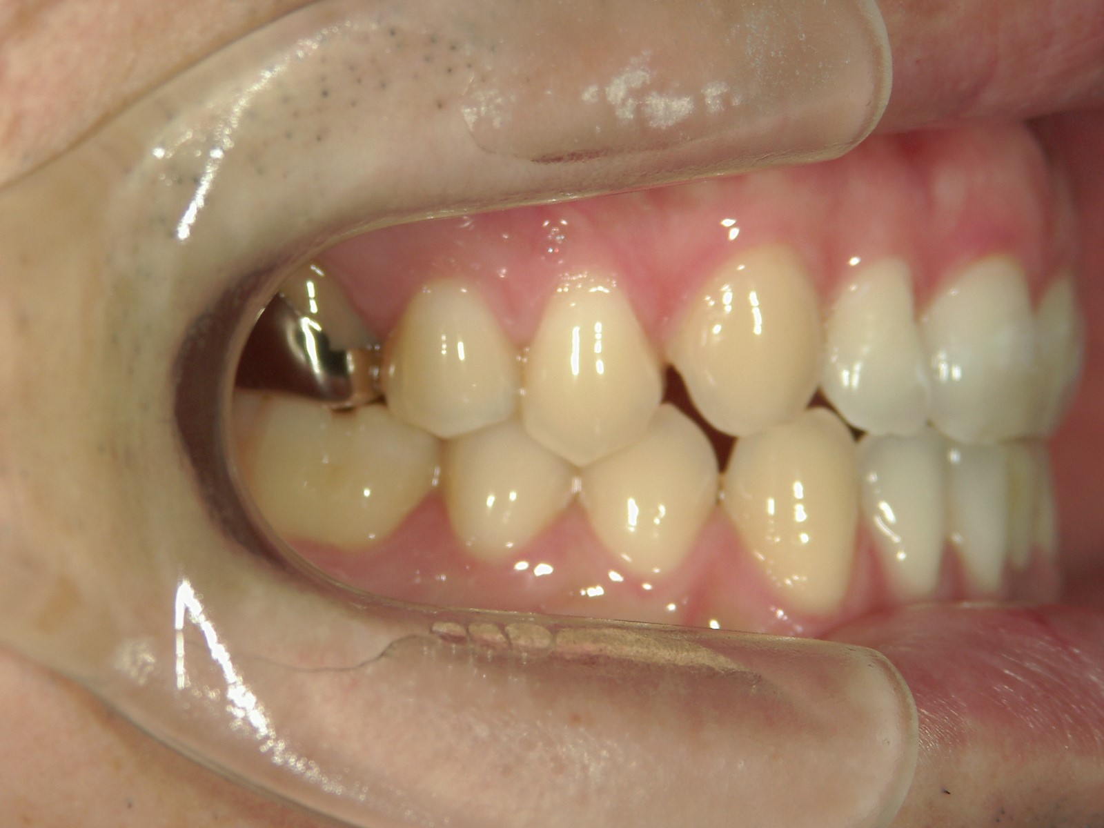 プチ舌側ワイヤー矯正　症例（10）