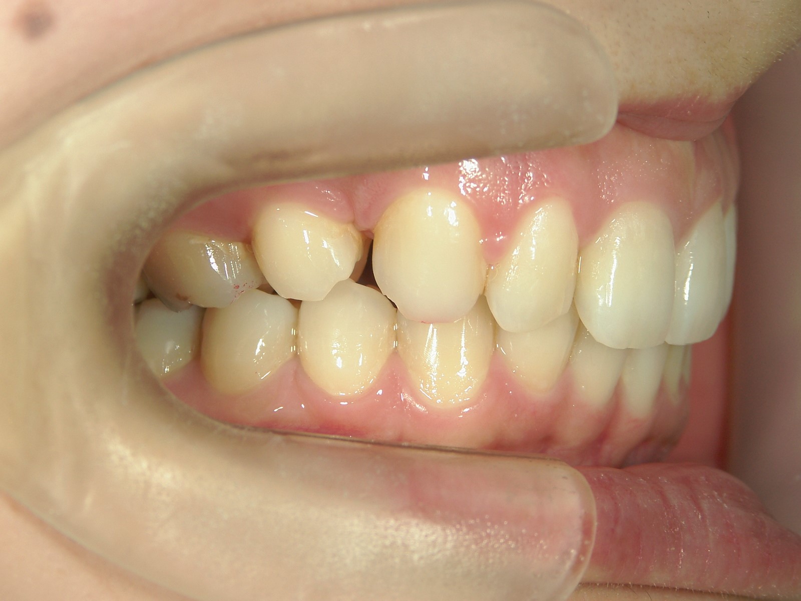 舌側ワイヤー矯正　症例（14）