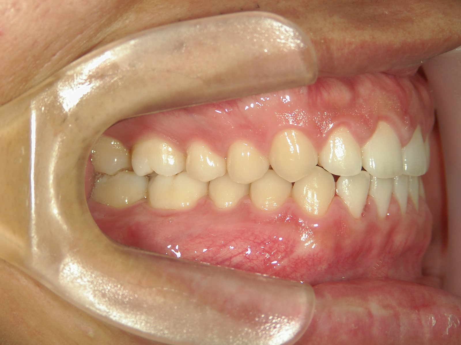 舌側ワイヤー矯正　症例（17）