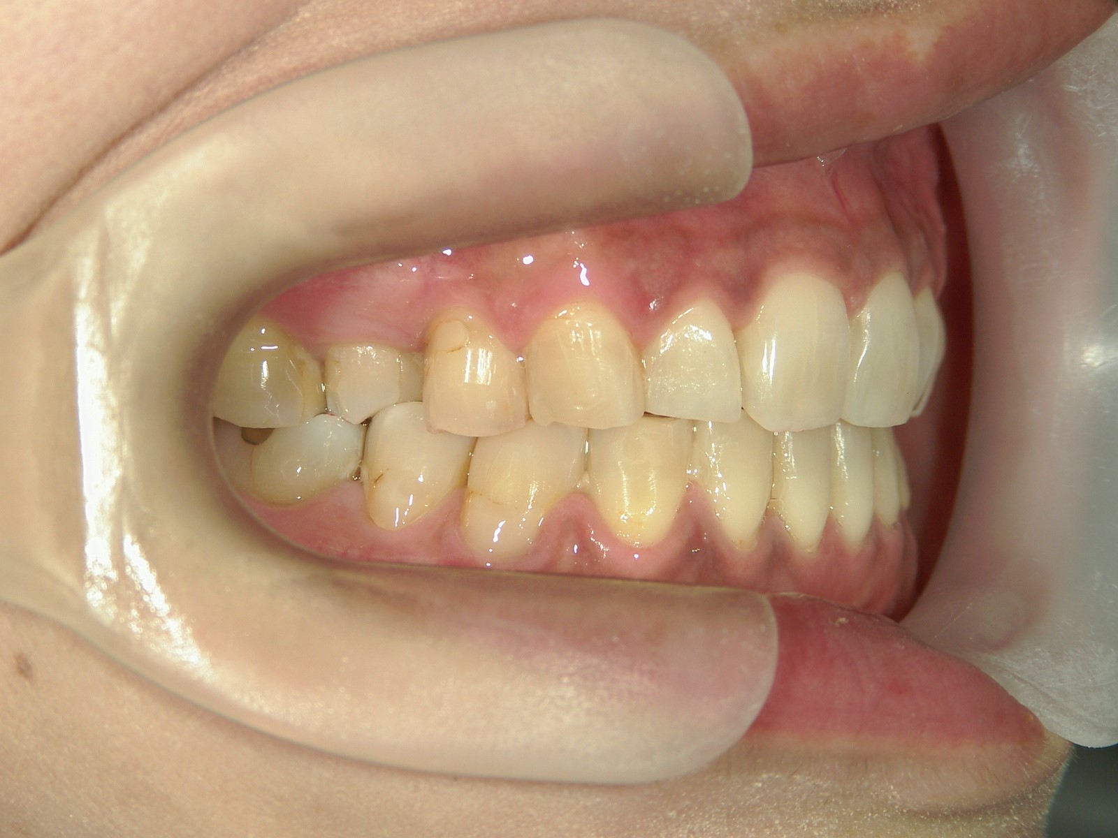 プチ舌側ワイヤー矯正　症例（18）