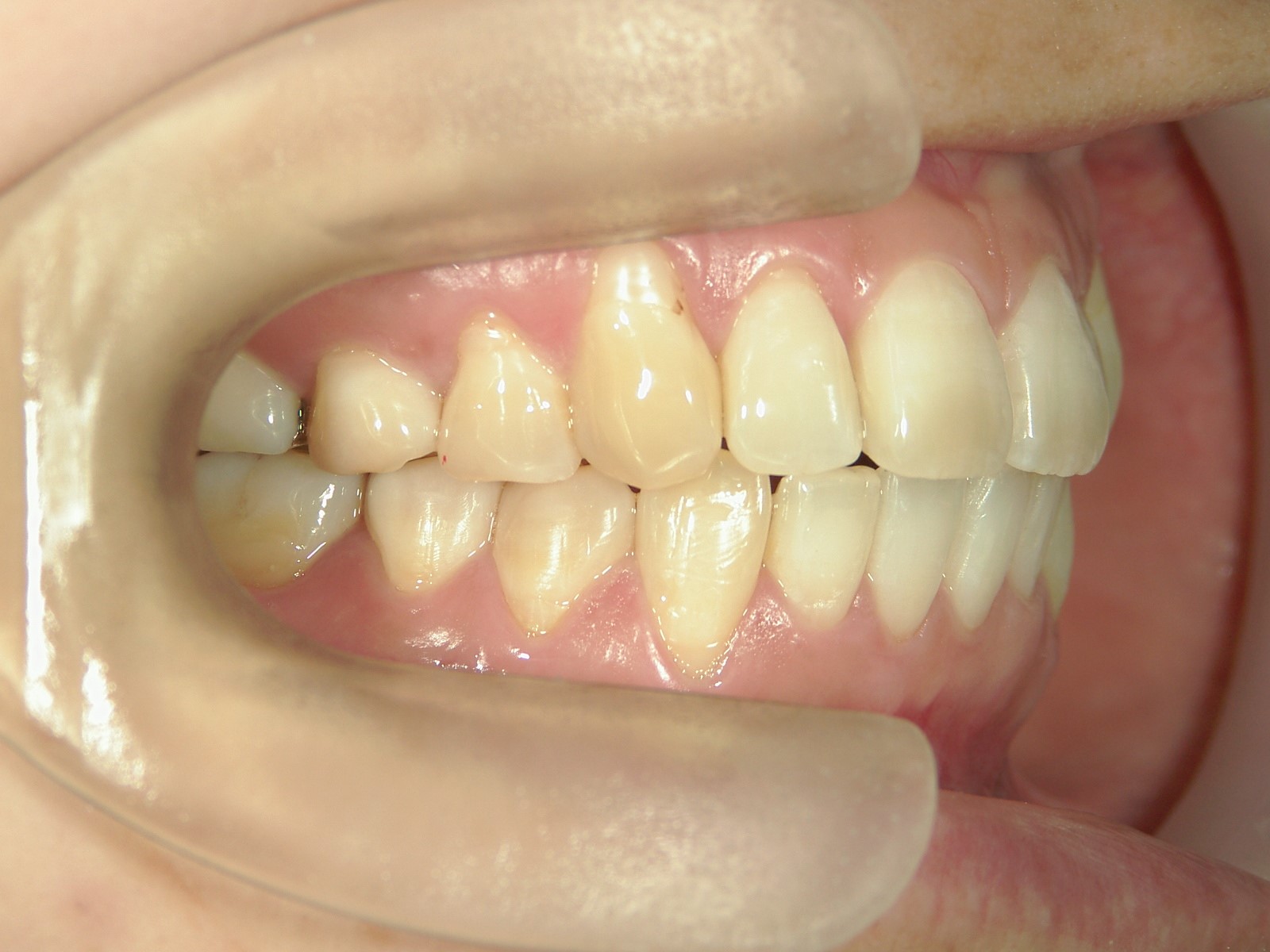 プチ舌側ワイヤー矯正　症例（19）