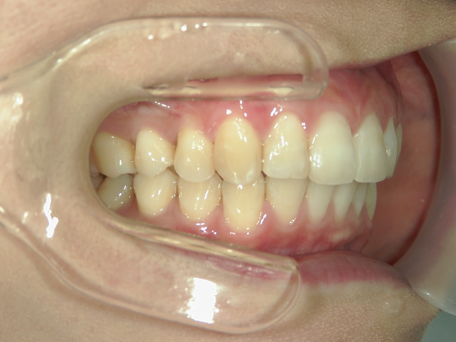 プチ舌側ワイヤー矯正　症例（24）