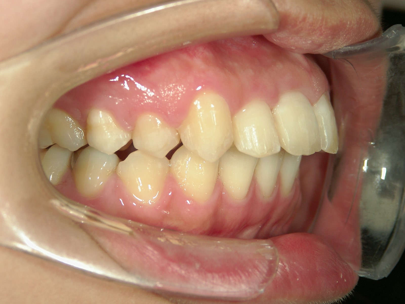 プチワイヤー矯正　症例（27）