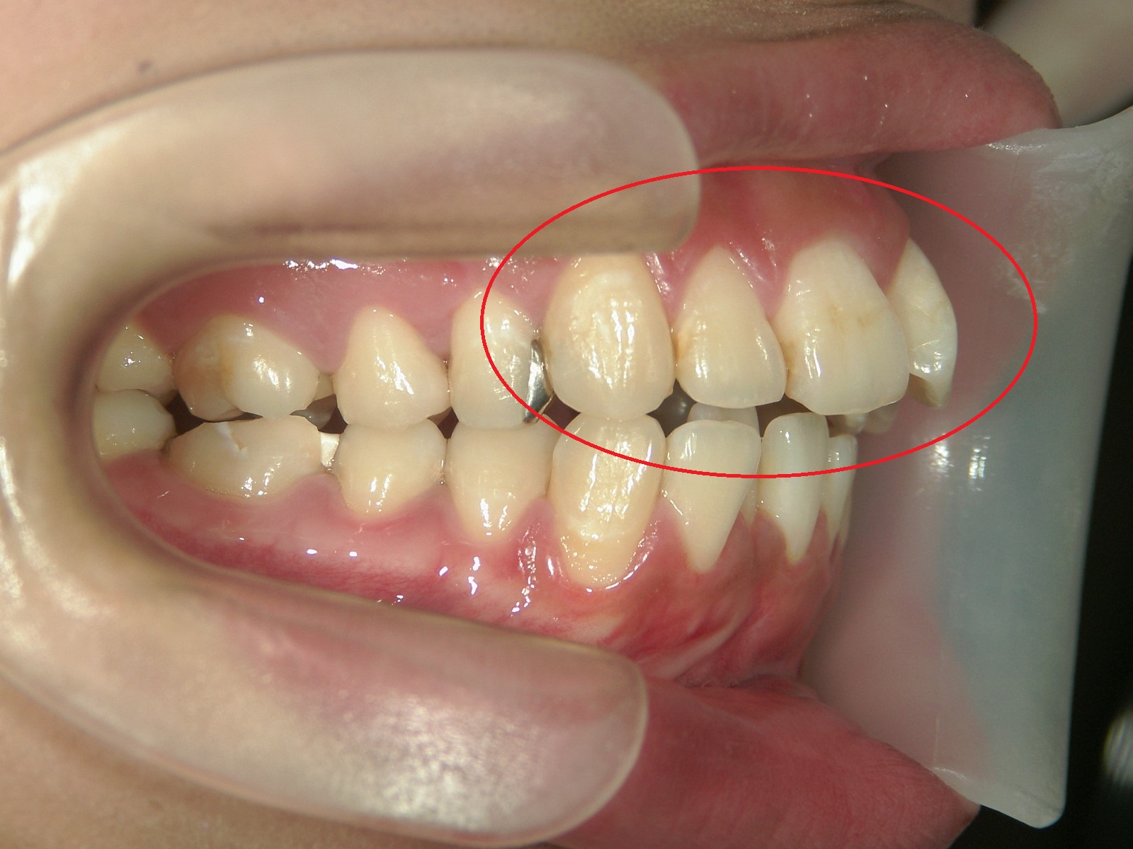 プチ舌側ワイヤー矯正　症例（20）