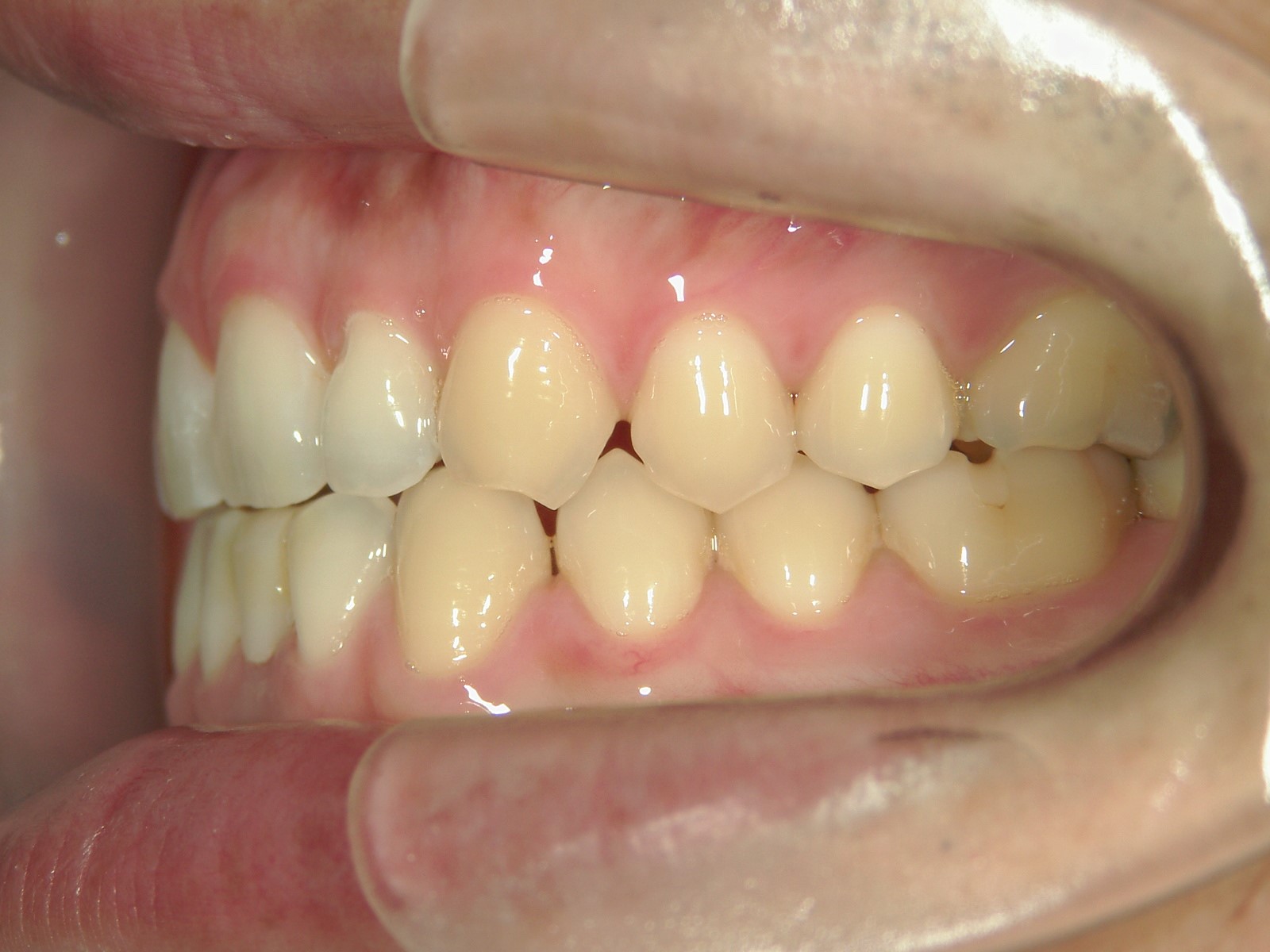 プチ舌側ワイヤー矯正　症例（10）