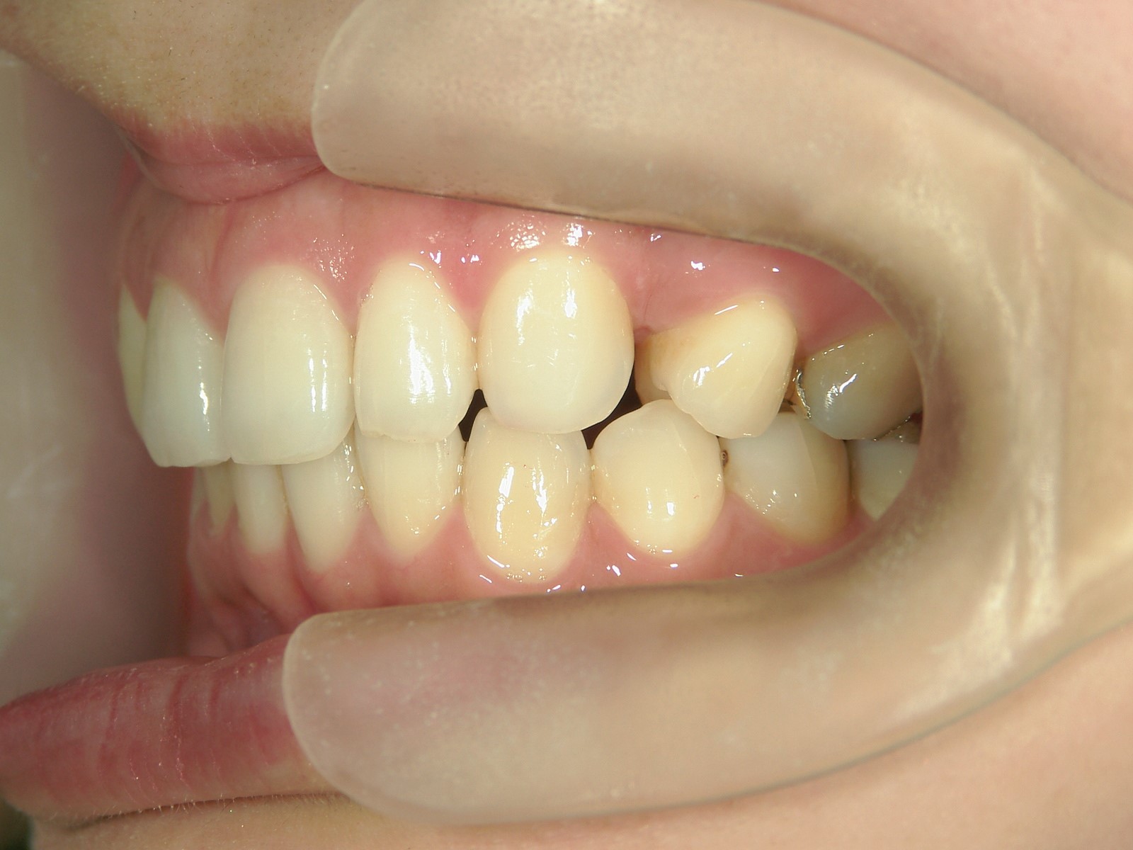 舌側ワイヤー矯正　症例（14）