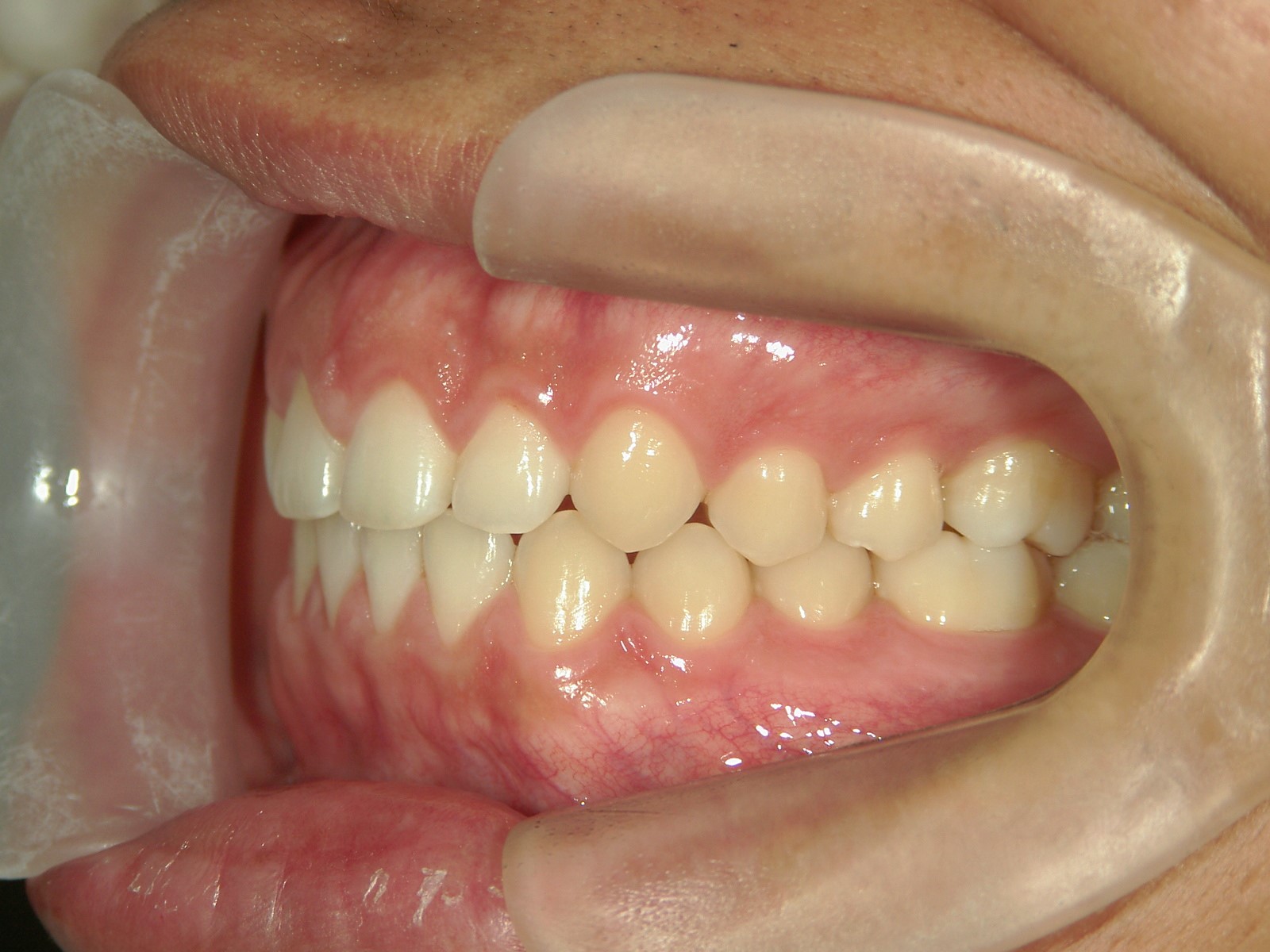 舌側ワイヤー矯正　症例（17）