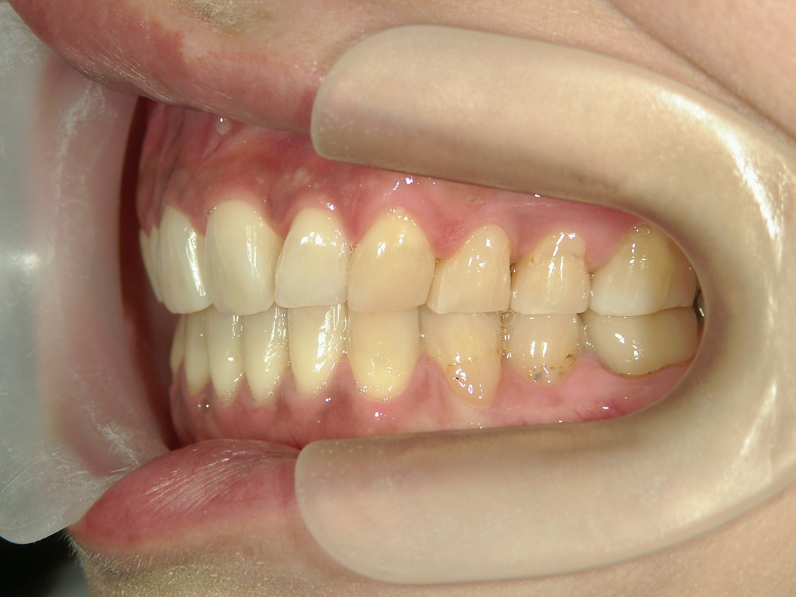 プチ舌側ワイヤー矯正　症例（18）