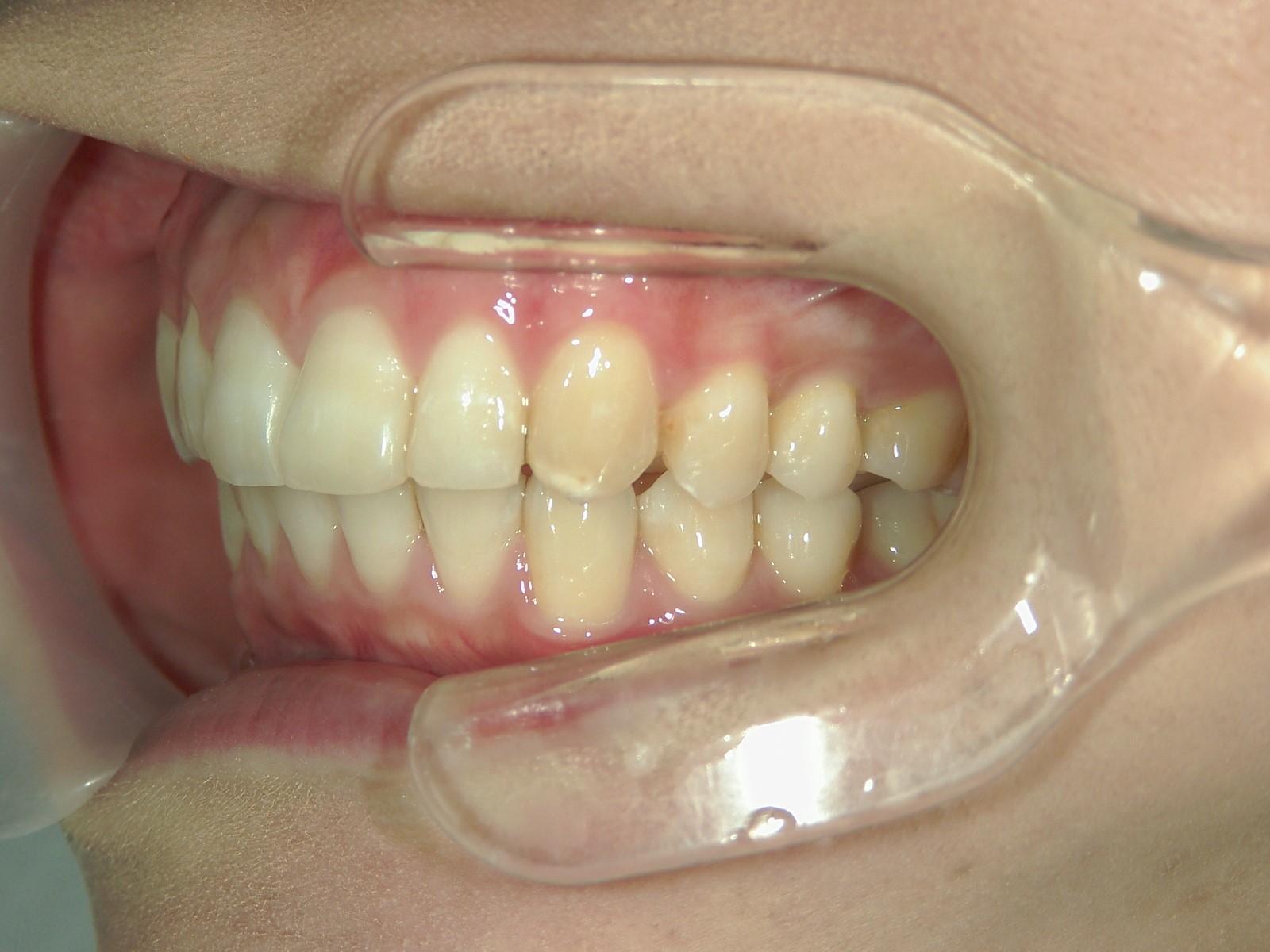 プチ舌側ワイヤー矯正　症例（24）