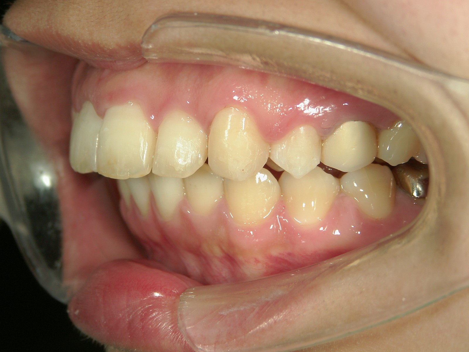 プチワイヤー矯正　症例（27）