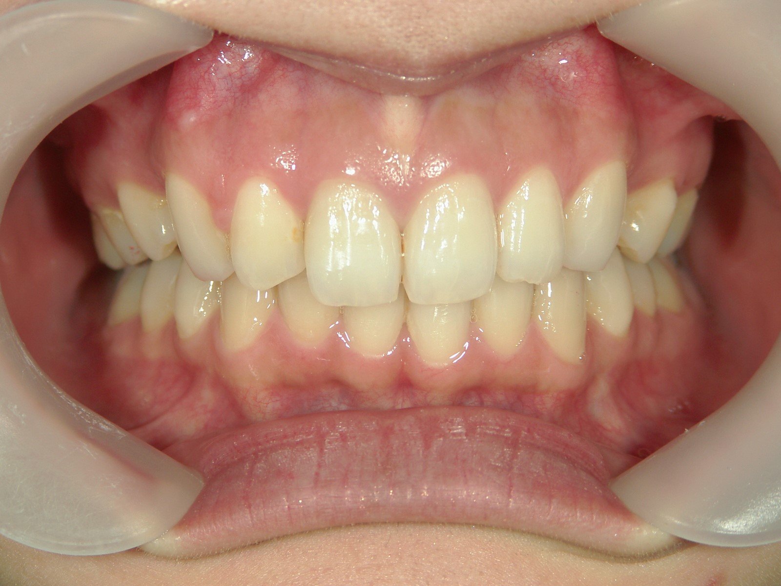 舌側ワイヤー矯正　症例（14）